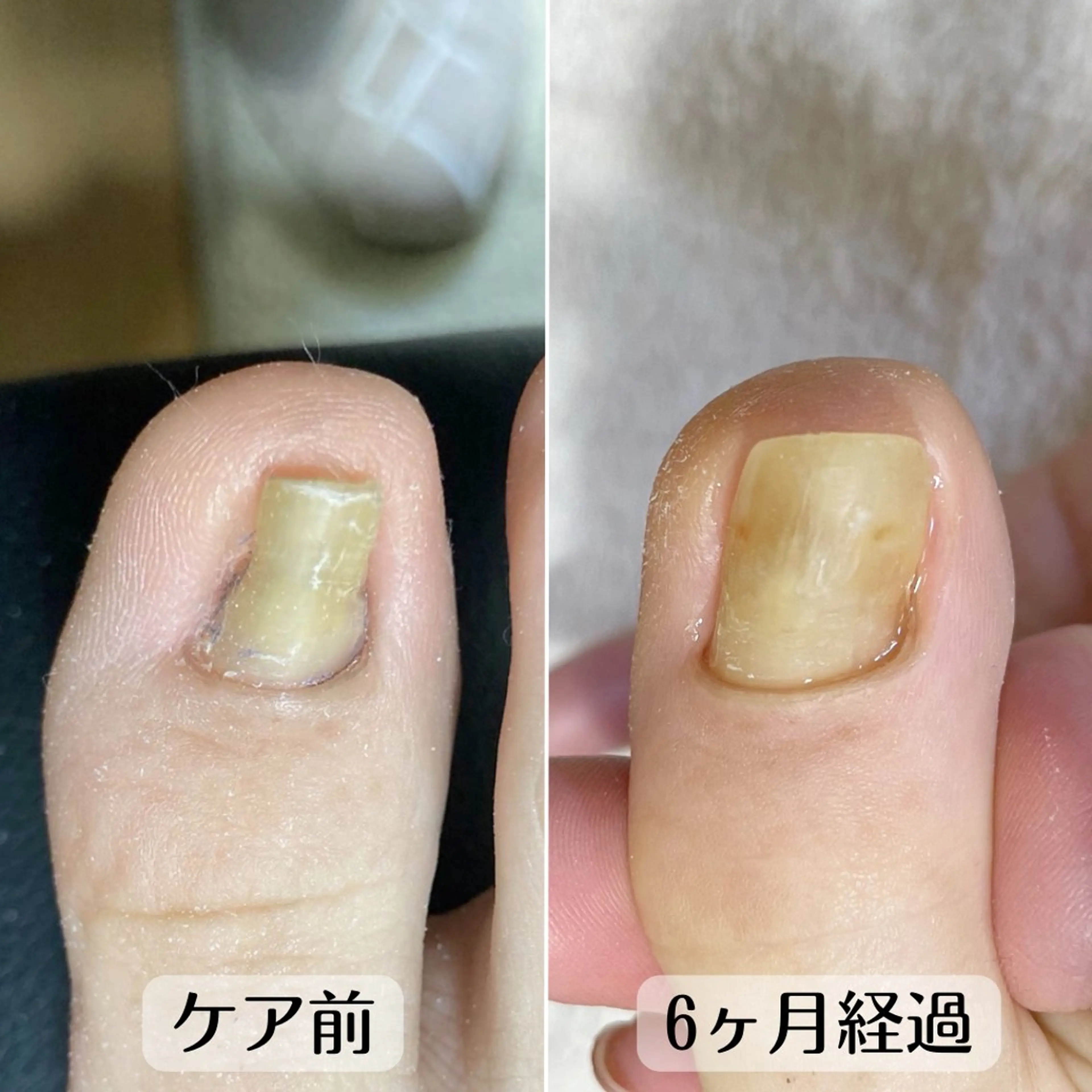 ネイル 深爪・巻き爪 専門サンセリテのネイルデザイン