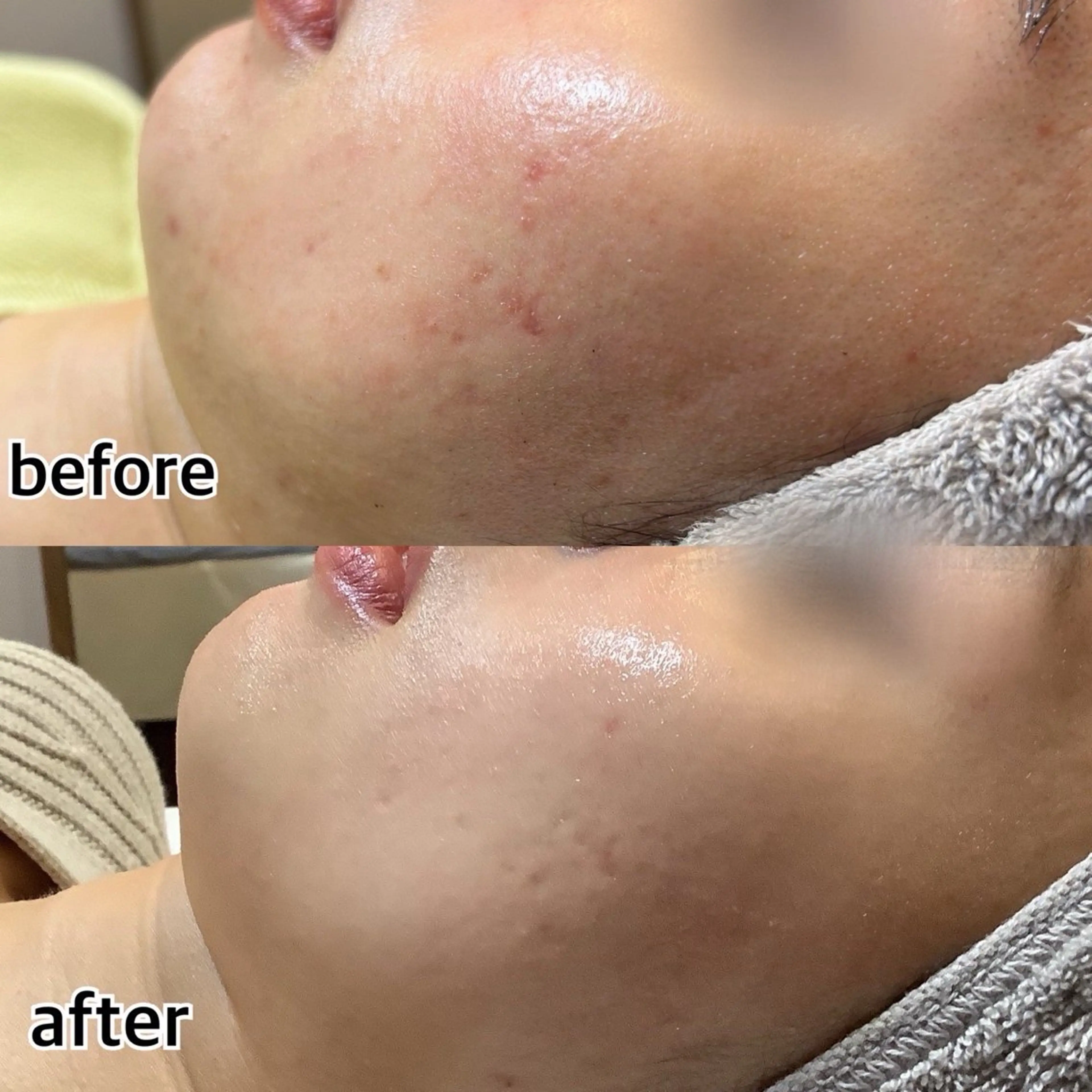 【皮脂スッキリ】ニキビ跡・肌荒れでお悩みの方！の写真