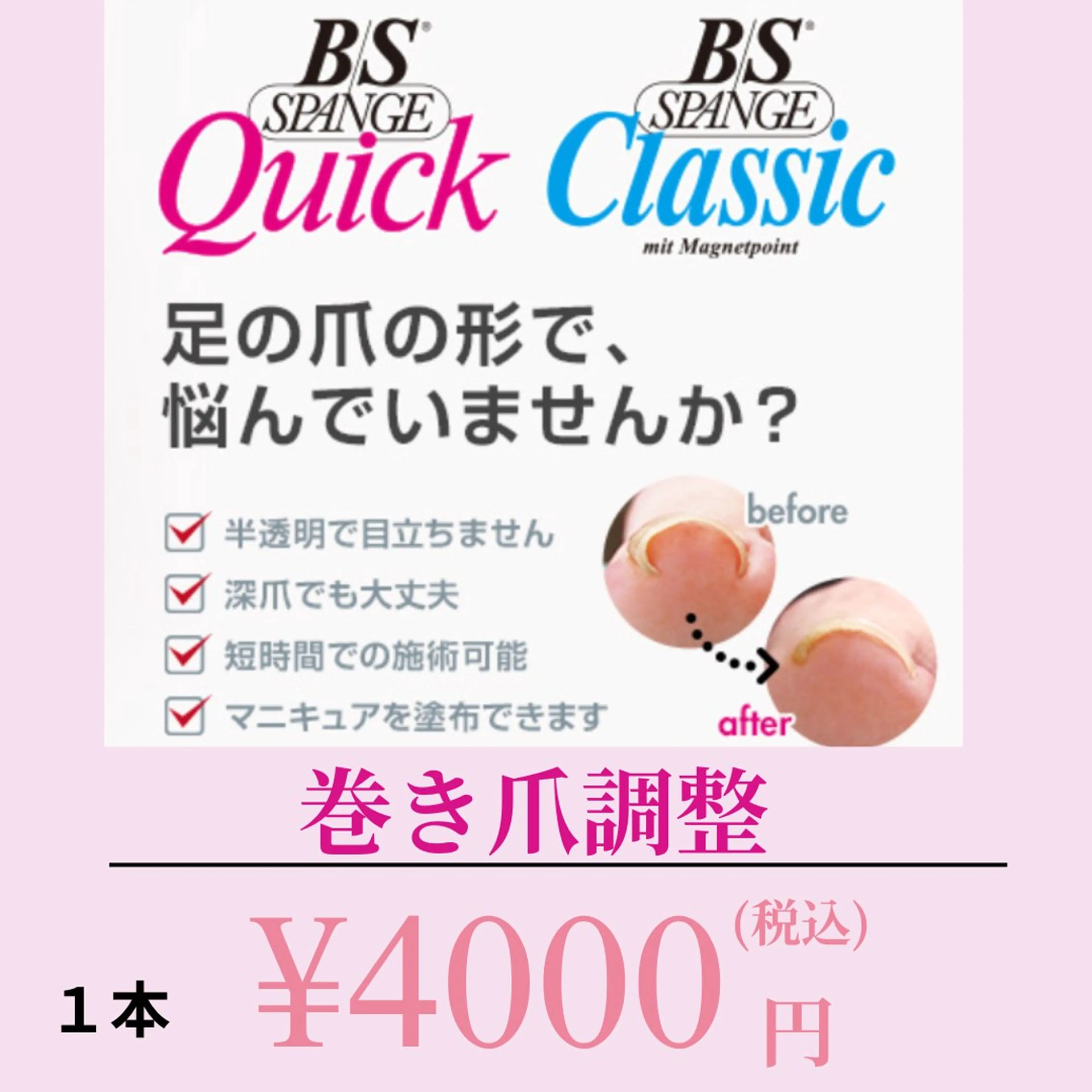 BS 巻き爪調整の写真