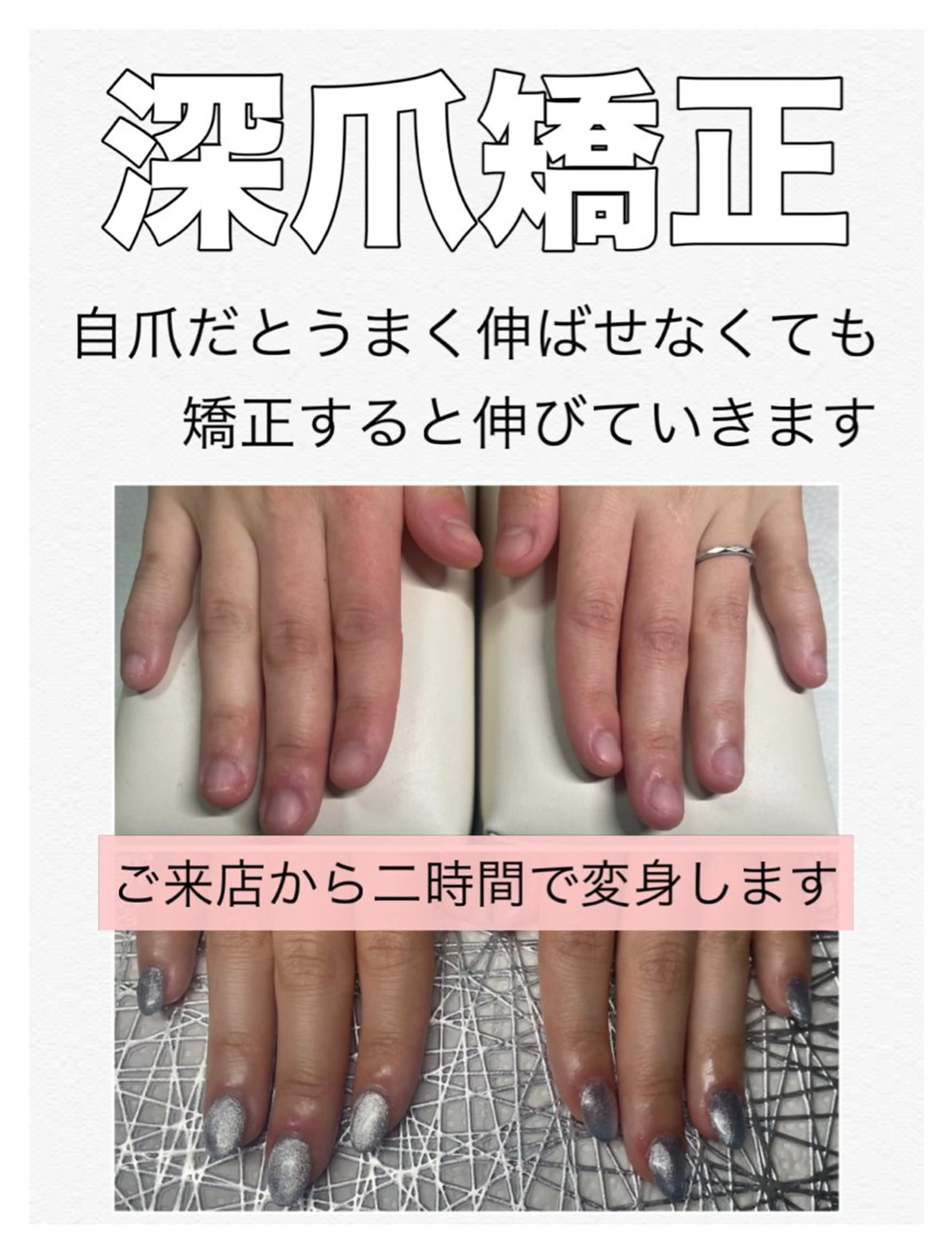 深爪矯正【長さ出し】◆カラーあり◆(オフ込)むしったり 割れたり 噛んで小さくなってしまった爪も美しく綺麗な状態に✧︎の写真