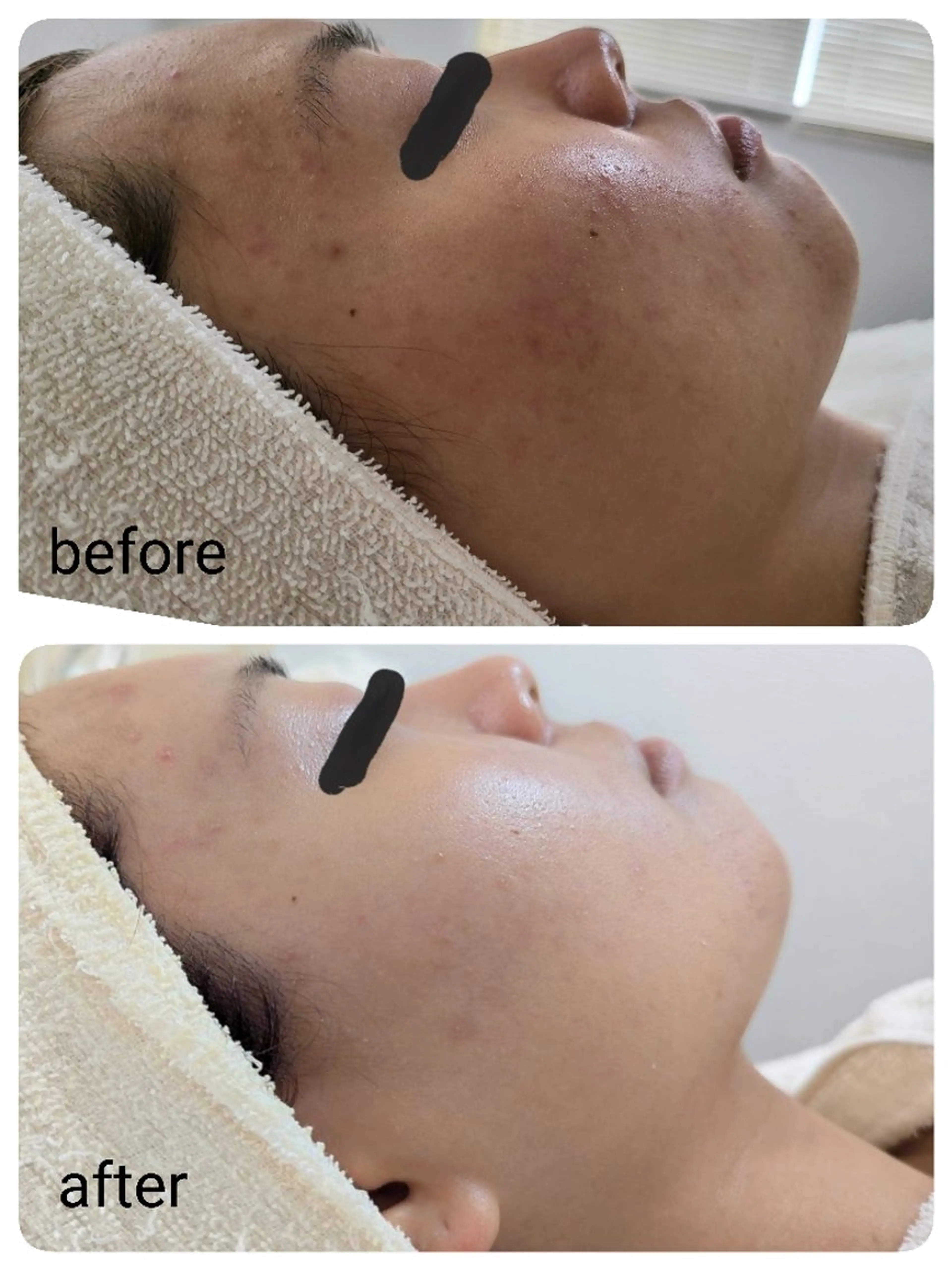 エステ レチノール/ニキビ/ 毛穴ケア　浅川のエステ・リラクイメージ