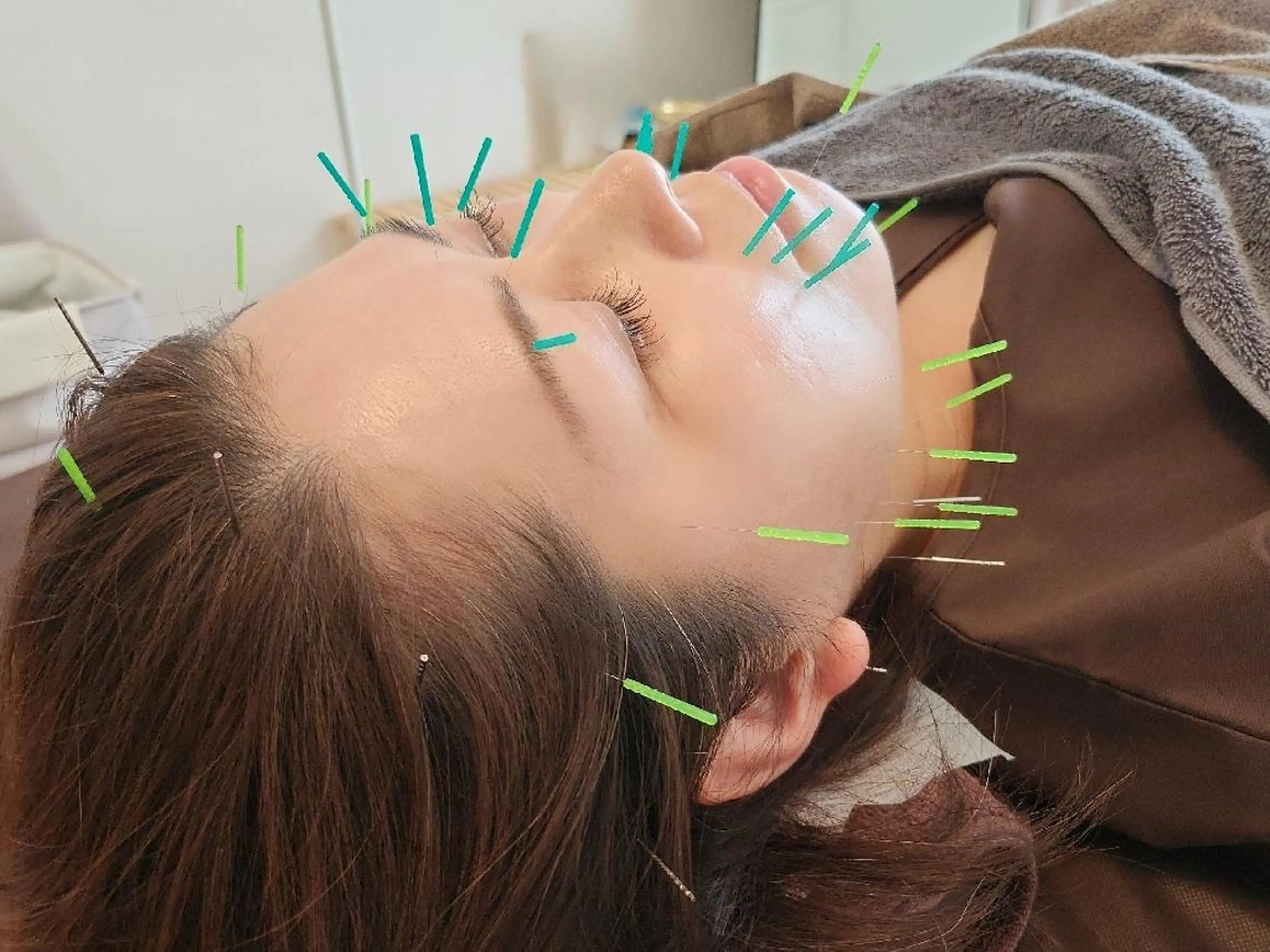 即効⚡小顔美容鍼🪡 むくみたるみ脂肪解消のエステ・リラクイメージ