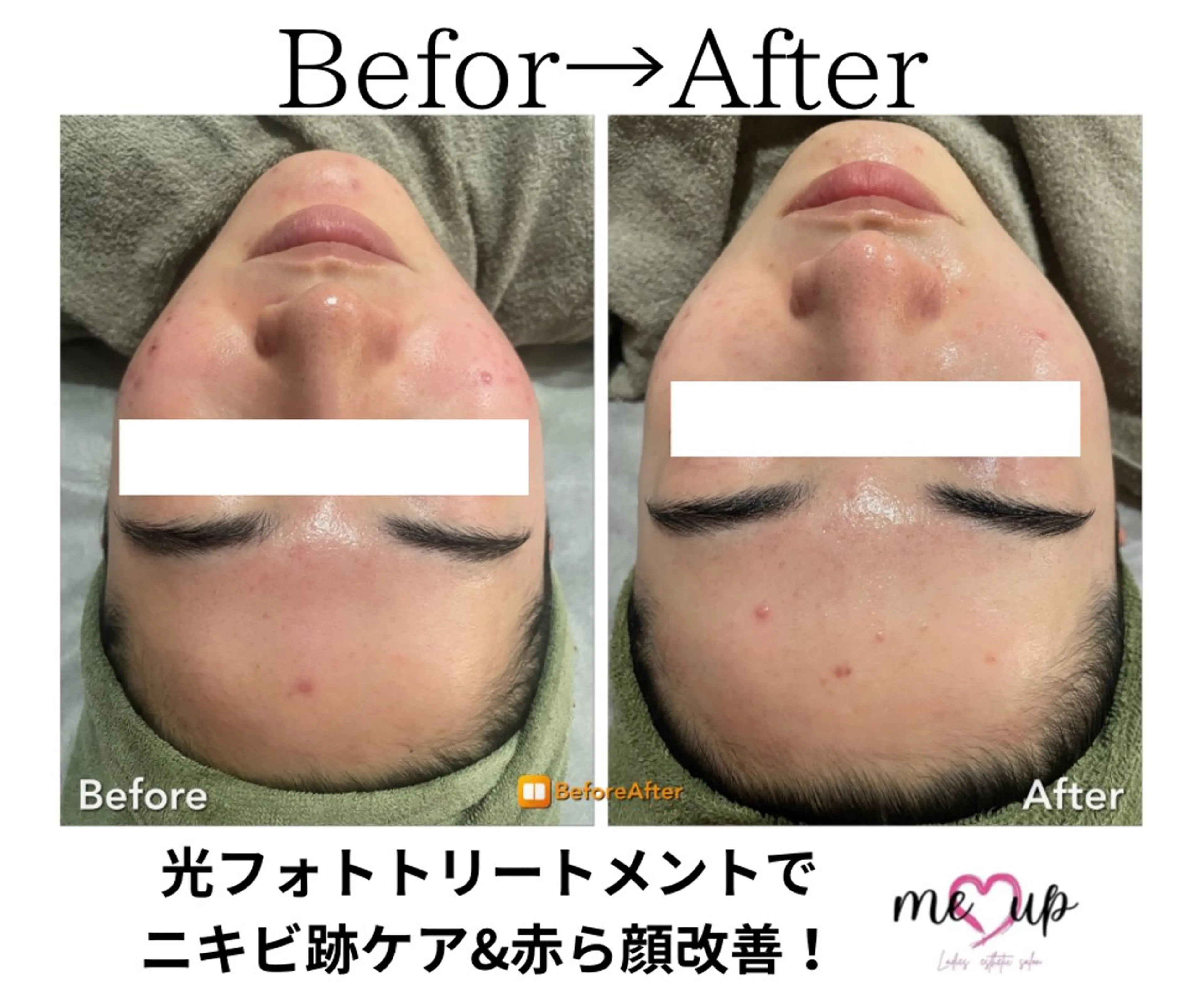 エステ Meupニキビ専門店 背中/ハーブ/肌管理のその他イメージ