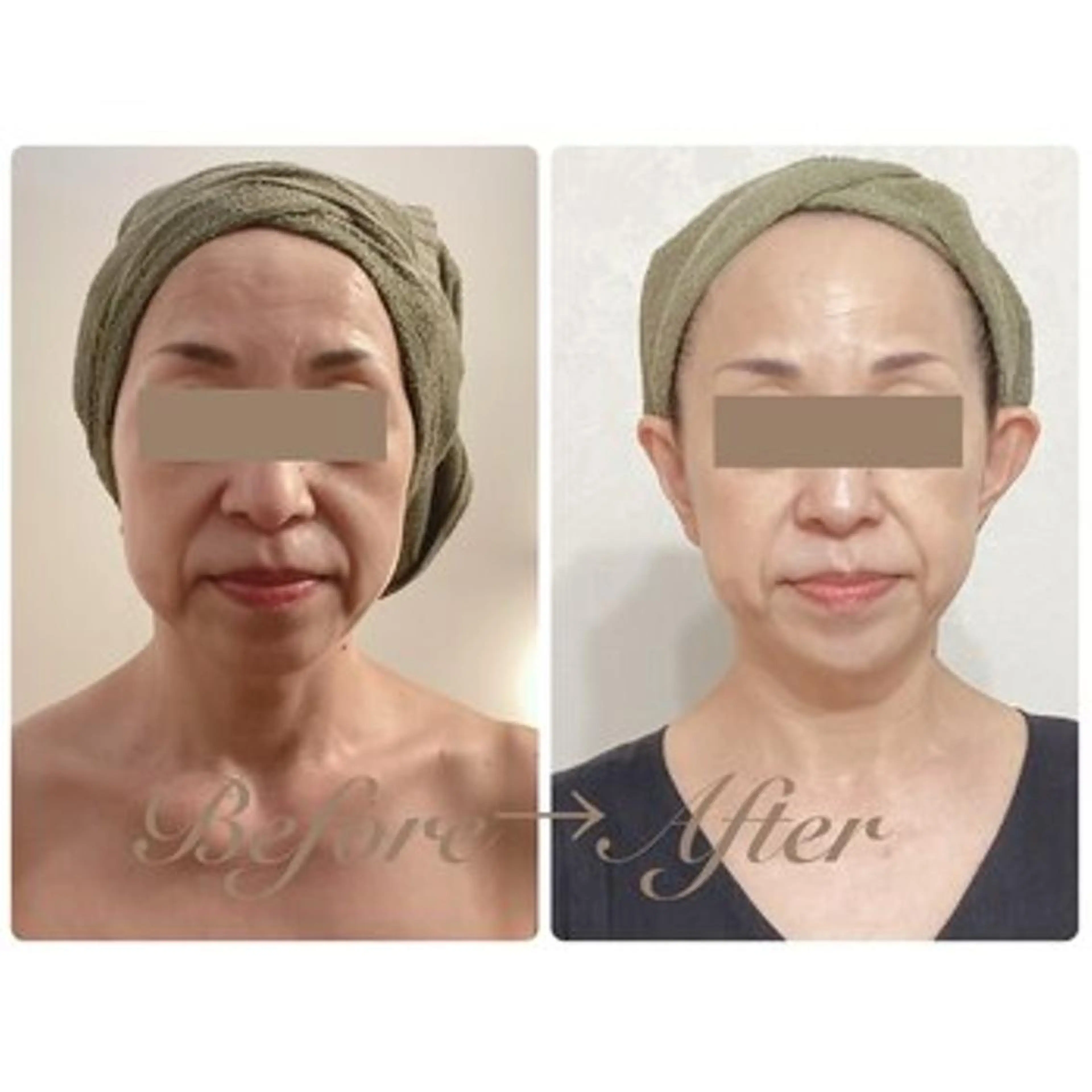 新生活応援♪【サロン人気NO.１】選べる小顔マシン◆憧れの小顔への写真