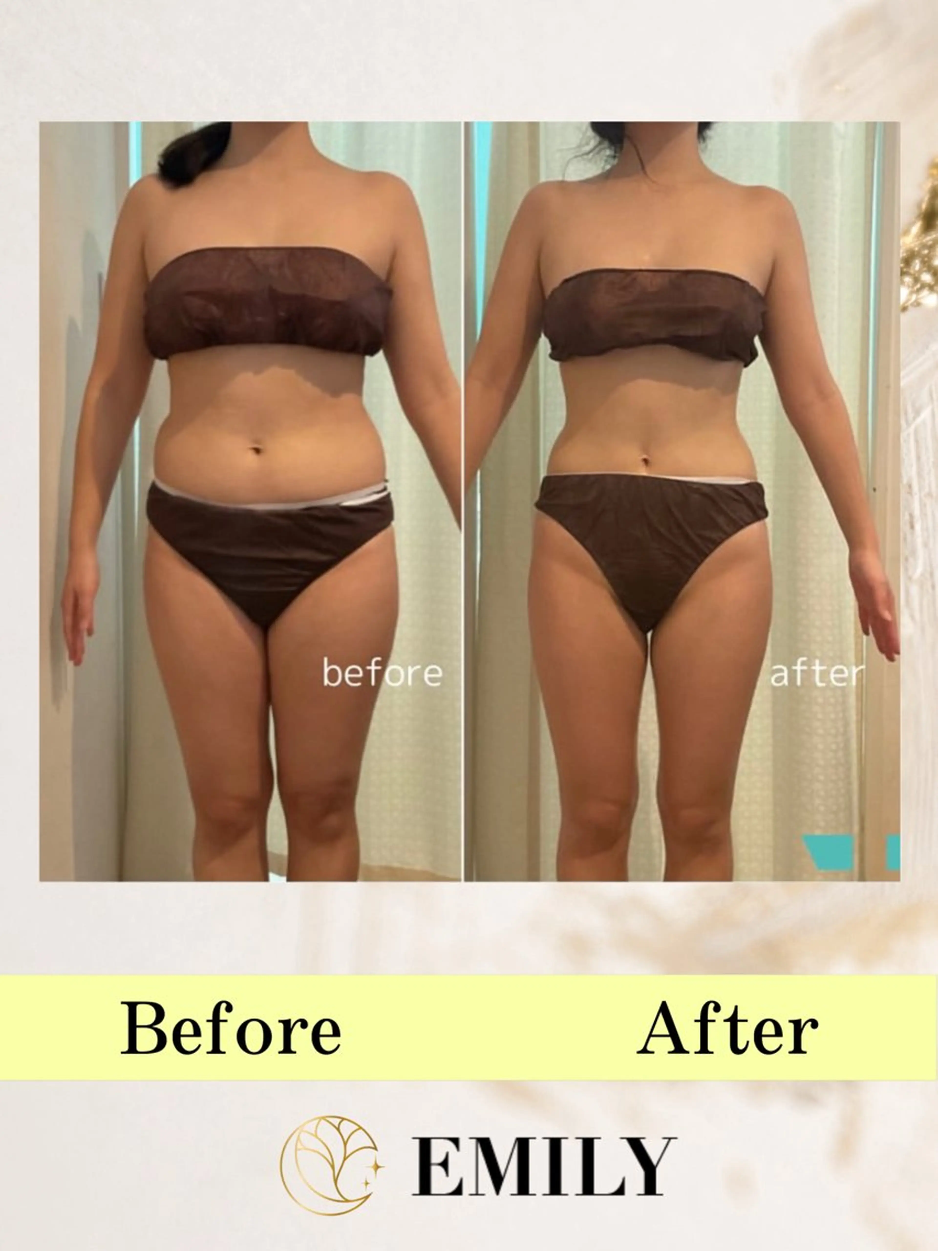 痩身キャビテーション(上半身or下半身)の写真