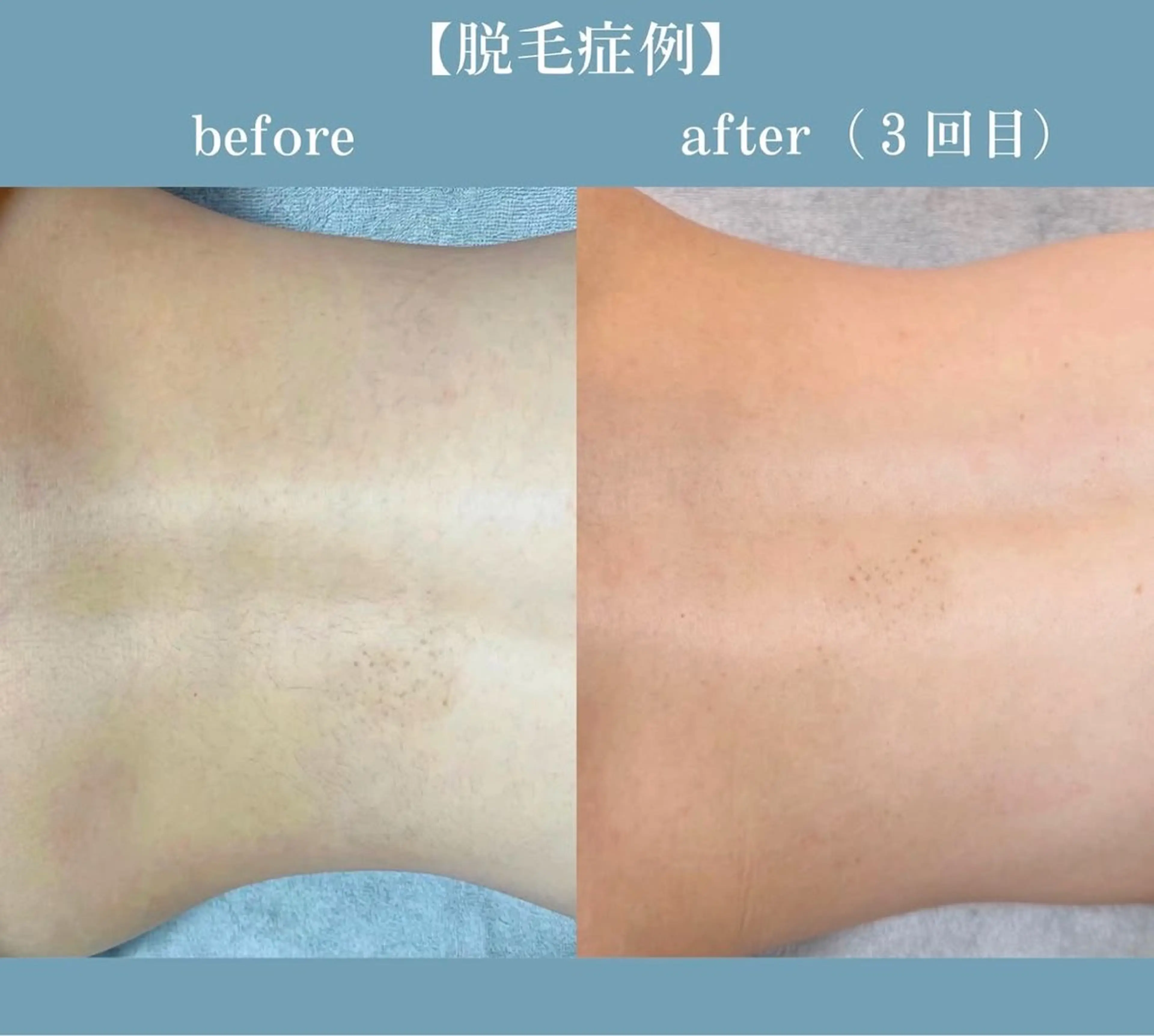 【京都市最安値】【シェービング】背中シェービング✨すっきりお背中✨の写真