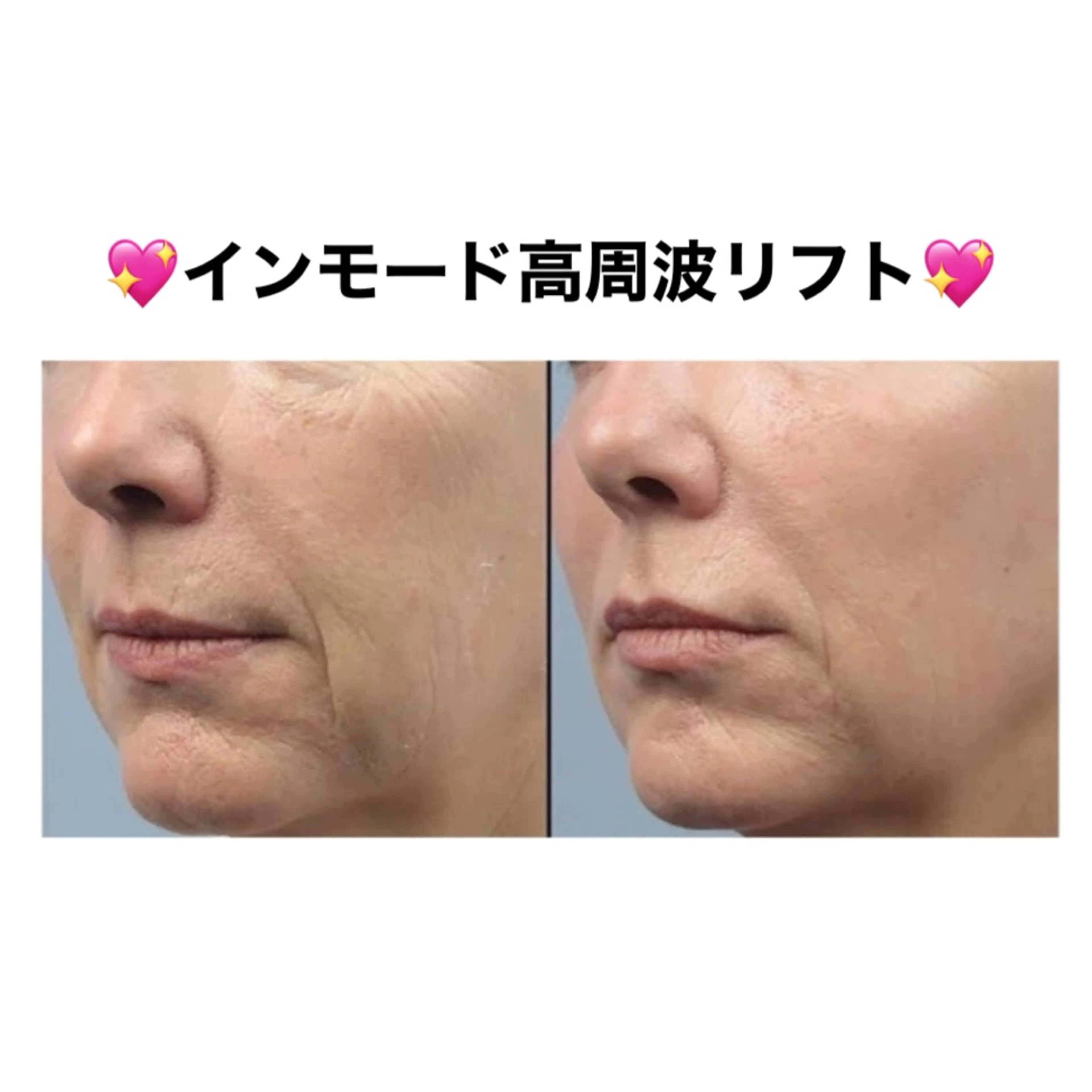 【はいふ越え❣️インモード高周波リフト】インモード高周波リフト×ローズピールで小顔に💖¥42,000⇒¥14,800の写真