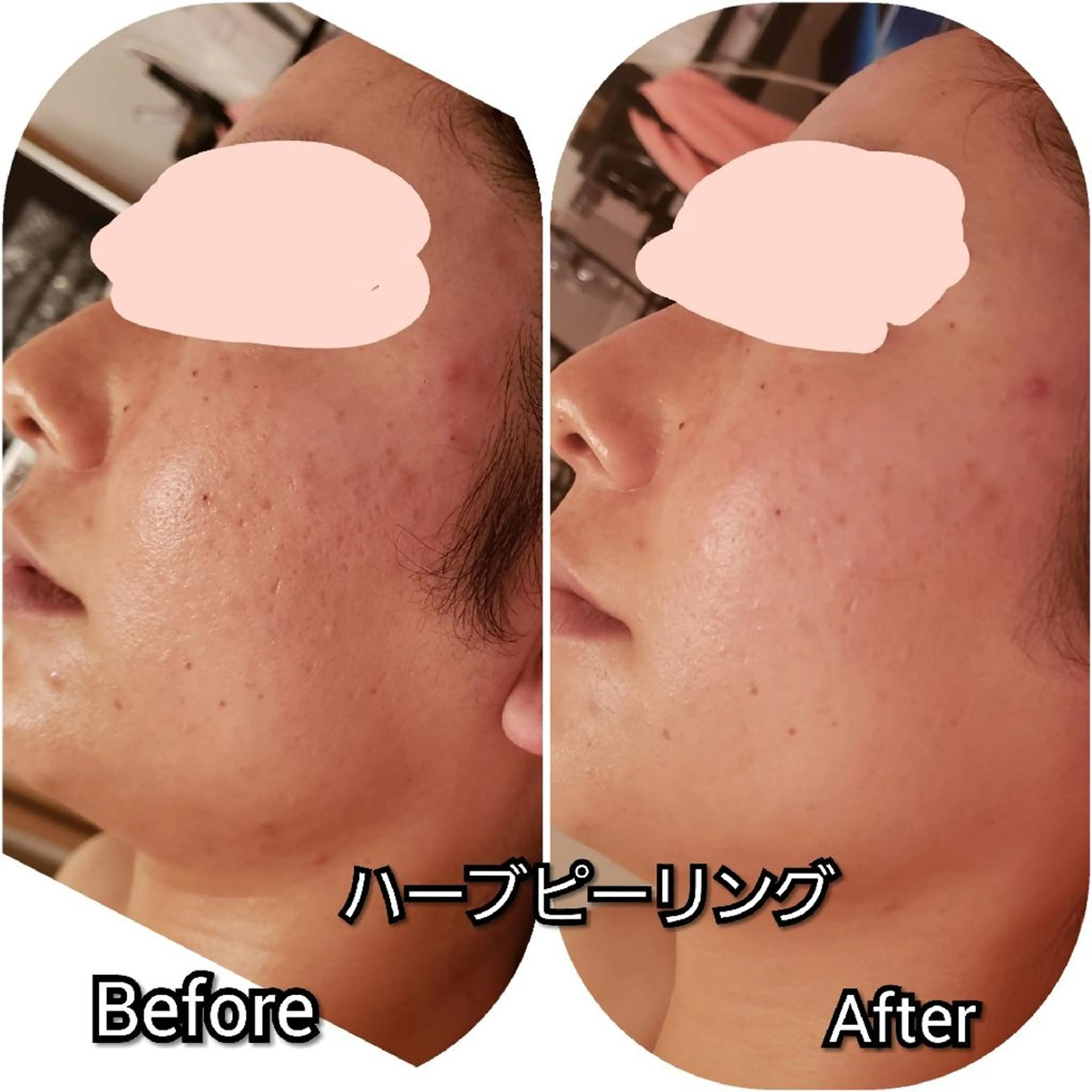 毛穴ケア くすみ肌 ハーブピーリングのエステ・リラクイメージ