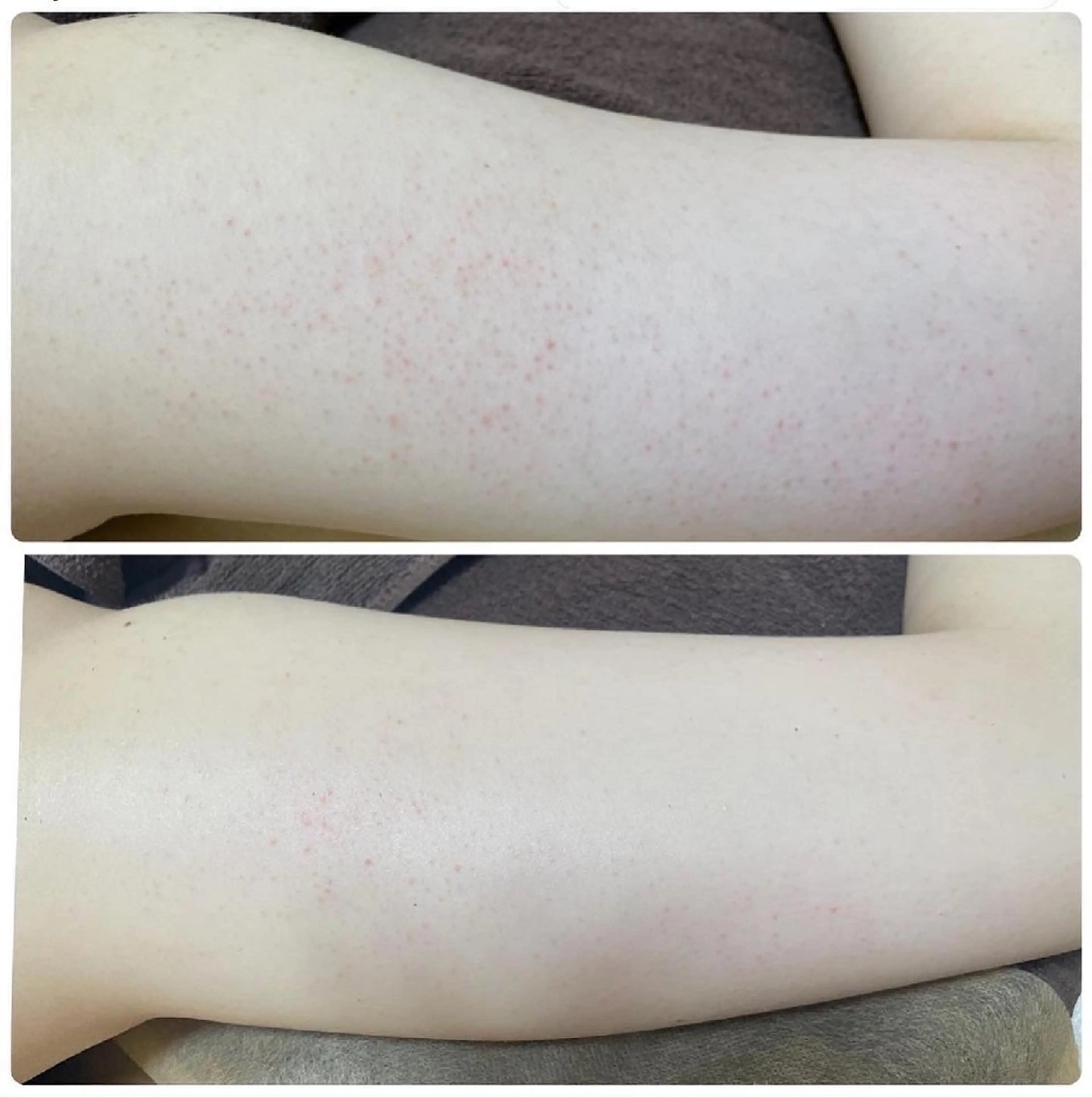 新規【ハーブピーリング】二の腕ハーブピーリングケアの写真