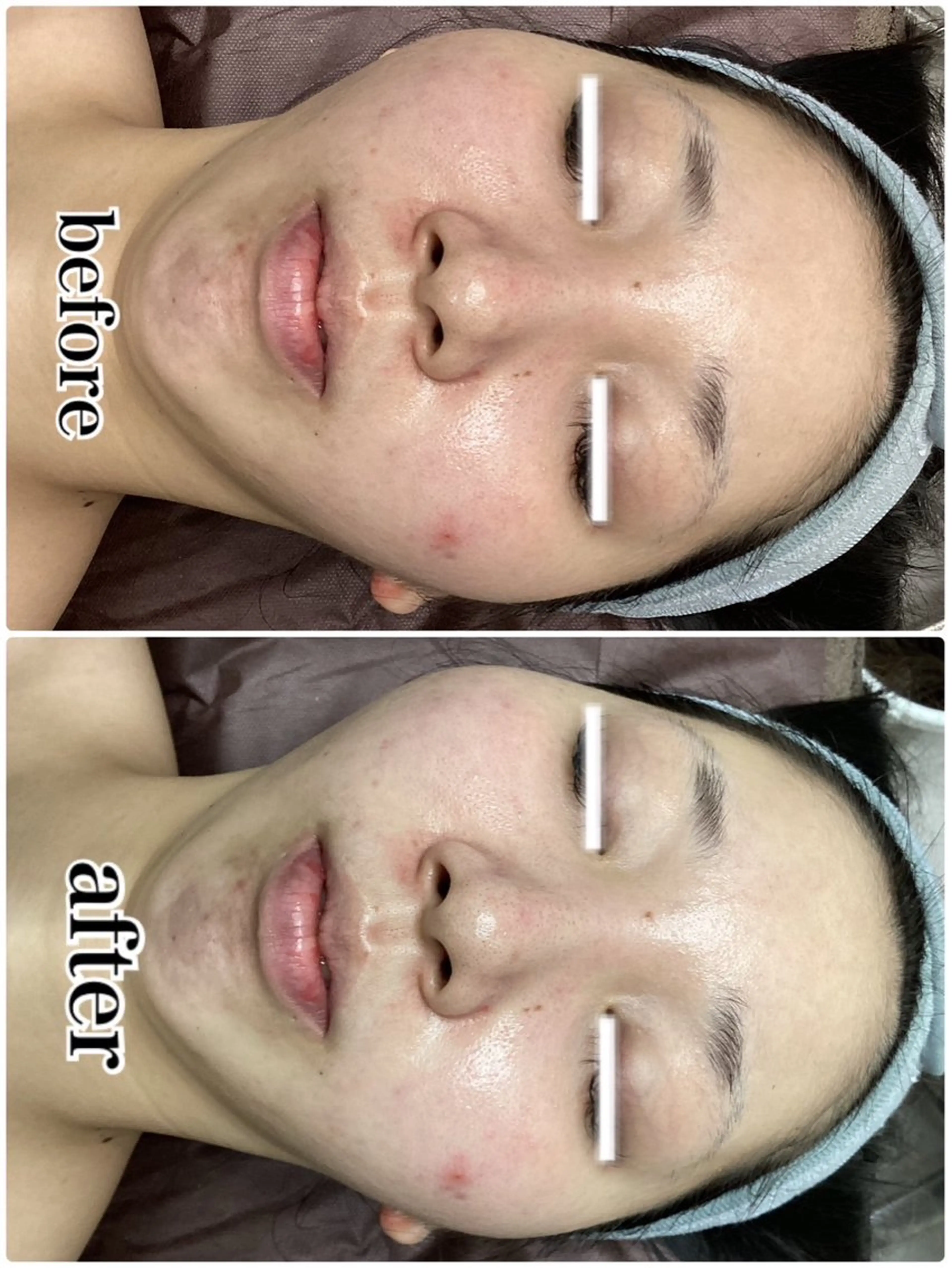 エステ ◯△□所属・最新美肌脱毛 韓国水光肌🫧のその他イメージ