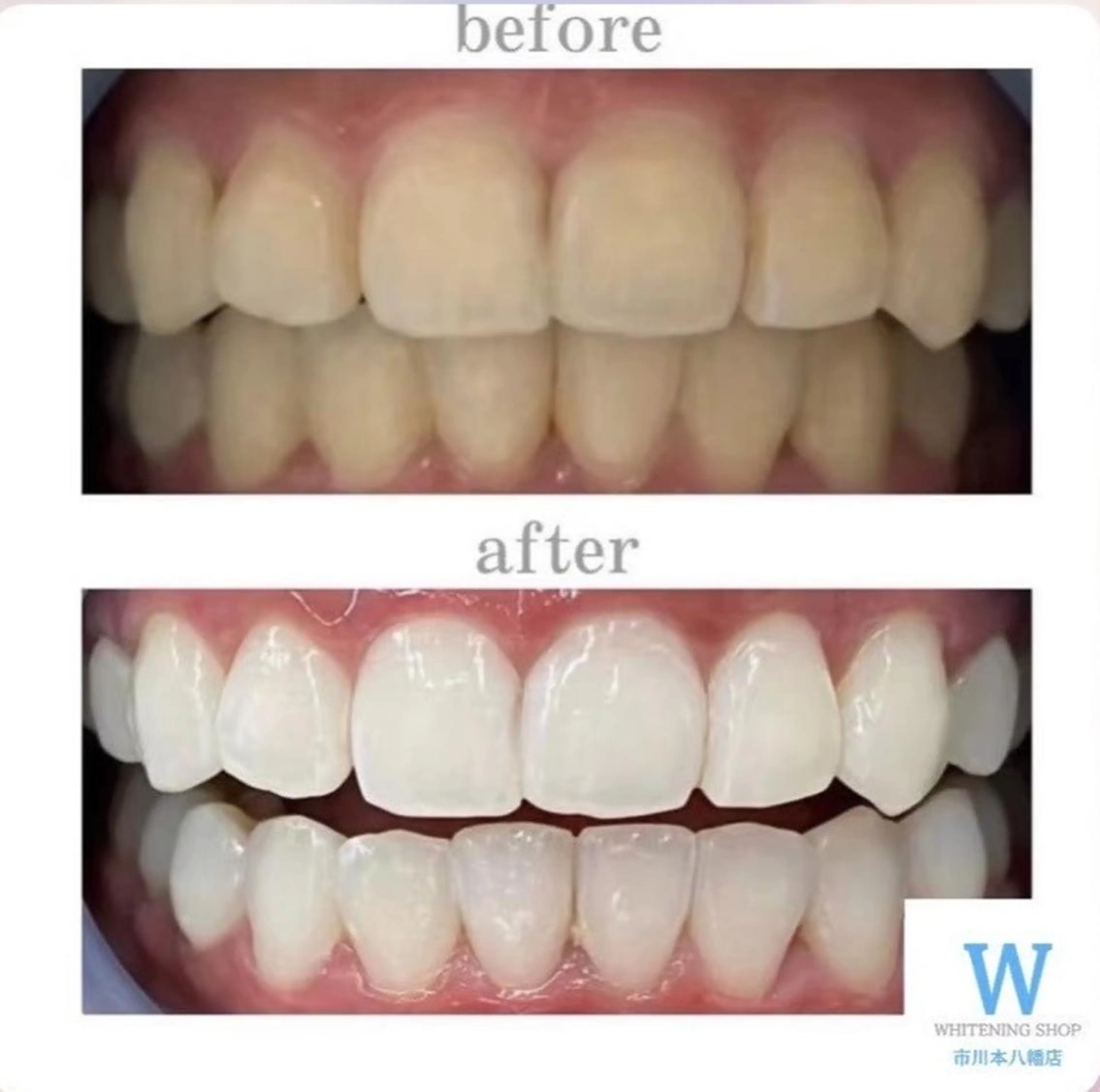 【お試し３回来店コース】ホワイトニング40分×3来店¥23,000→¥16,200の写真