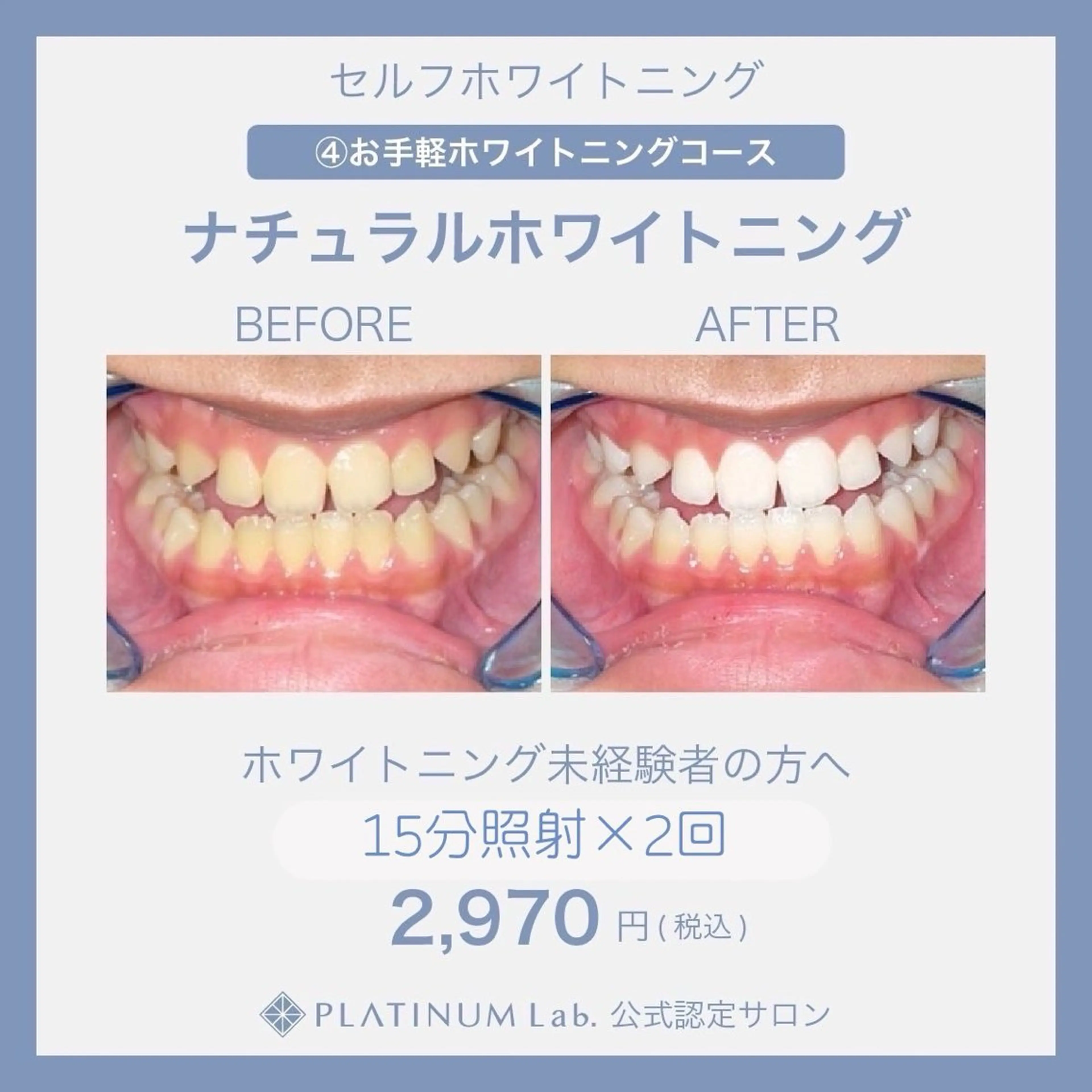 【お試しプラン】高濃度ハイパワーホワイトニング(15分×2回) メンズ歓迎👨✨の写真