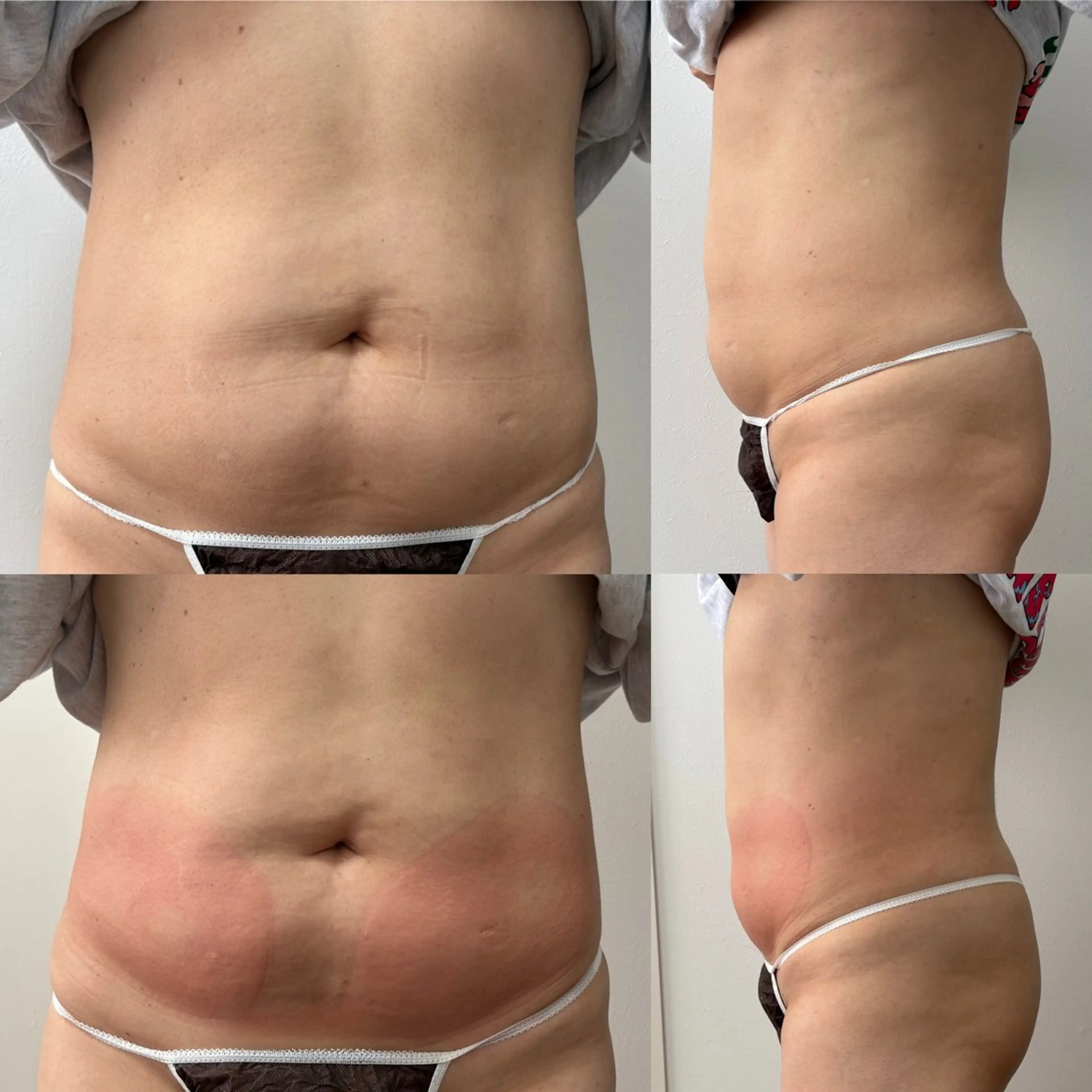 Miiju.所属・Miiju. 石巻市 脂肪冷却  鈴木のエステ・リラクイメージ