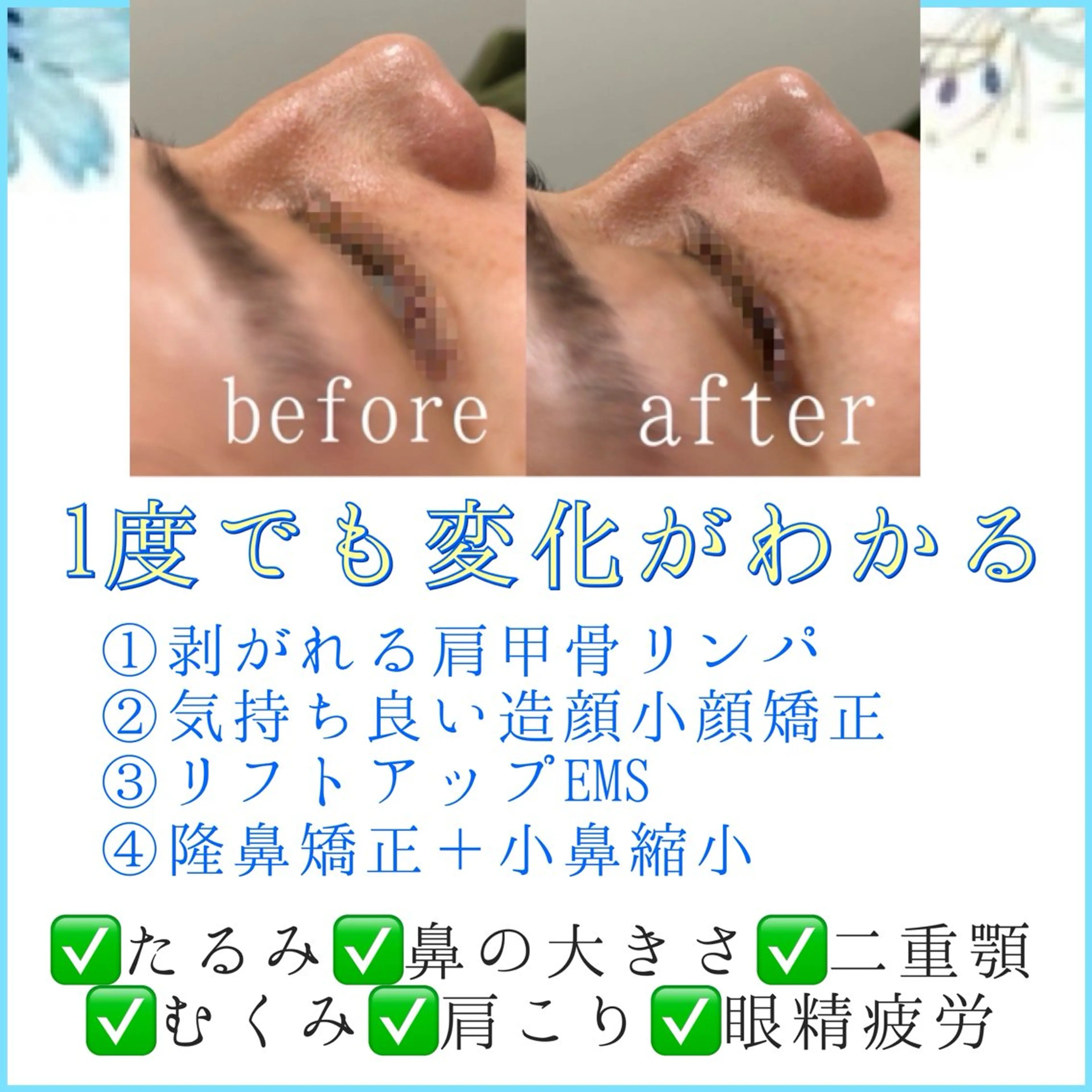 🌈効果実感の小顔矯正＋小鼻を高く&小さく🌈隆鼻矯正＋造顔小顔矯正＋首肩＋ems💎理想のお鼻を形成✨の写真
