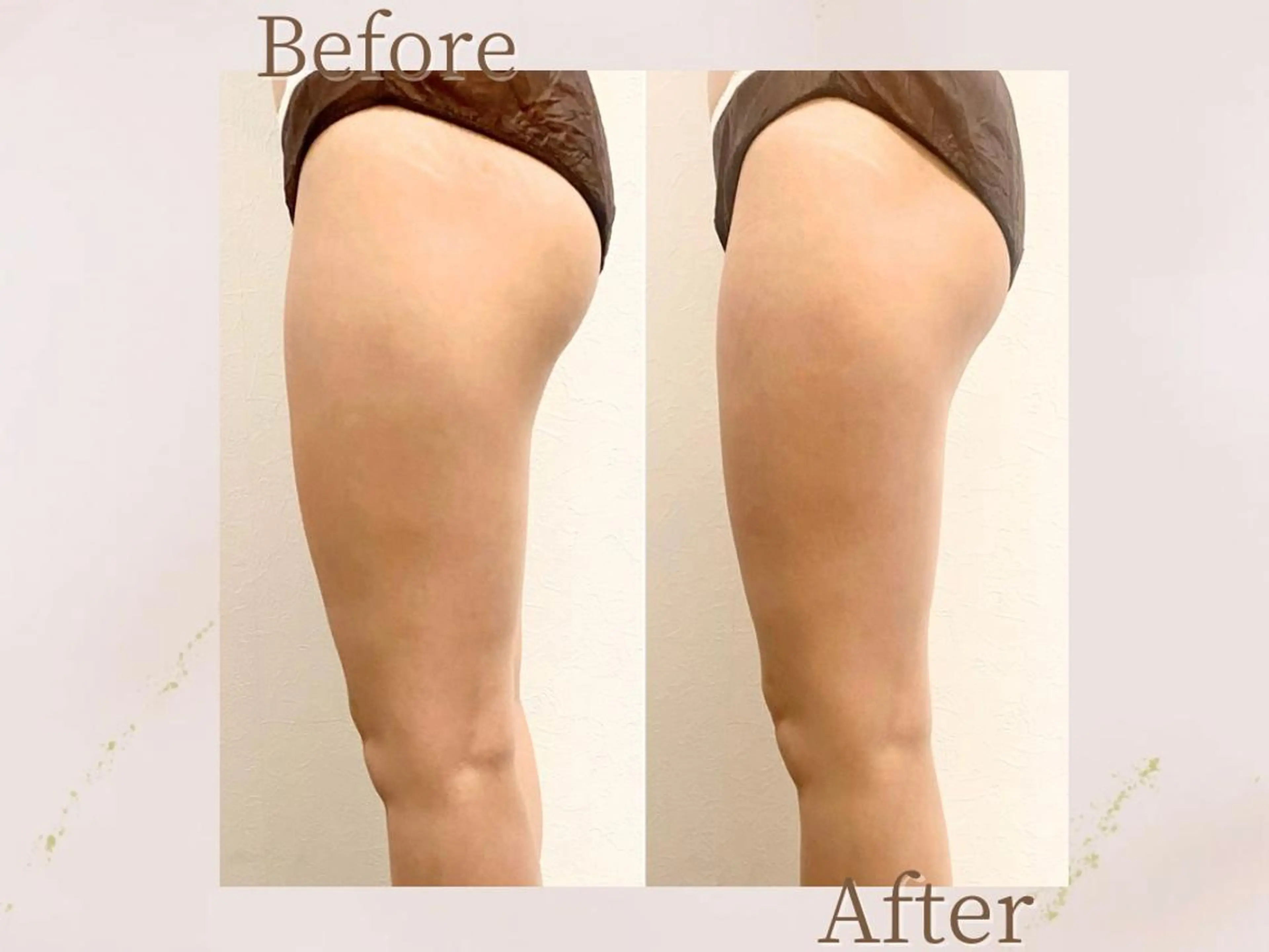 【ミニモ限定価格★モニター美脚痩身】キャビテーション×EMS ¥22,000→10,000の写真