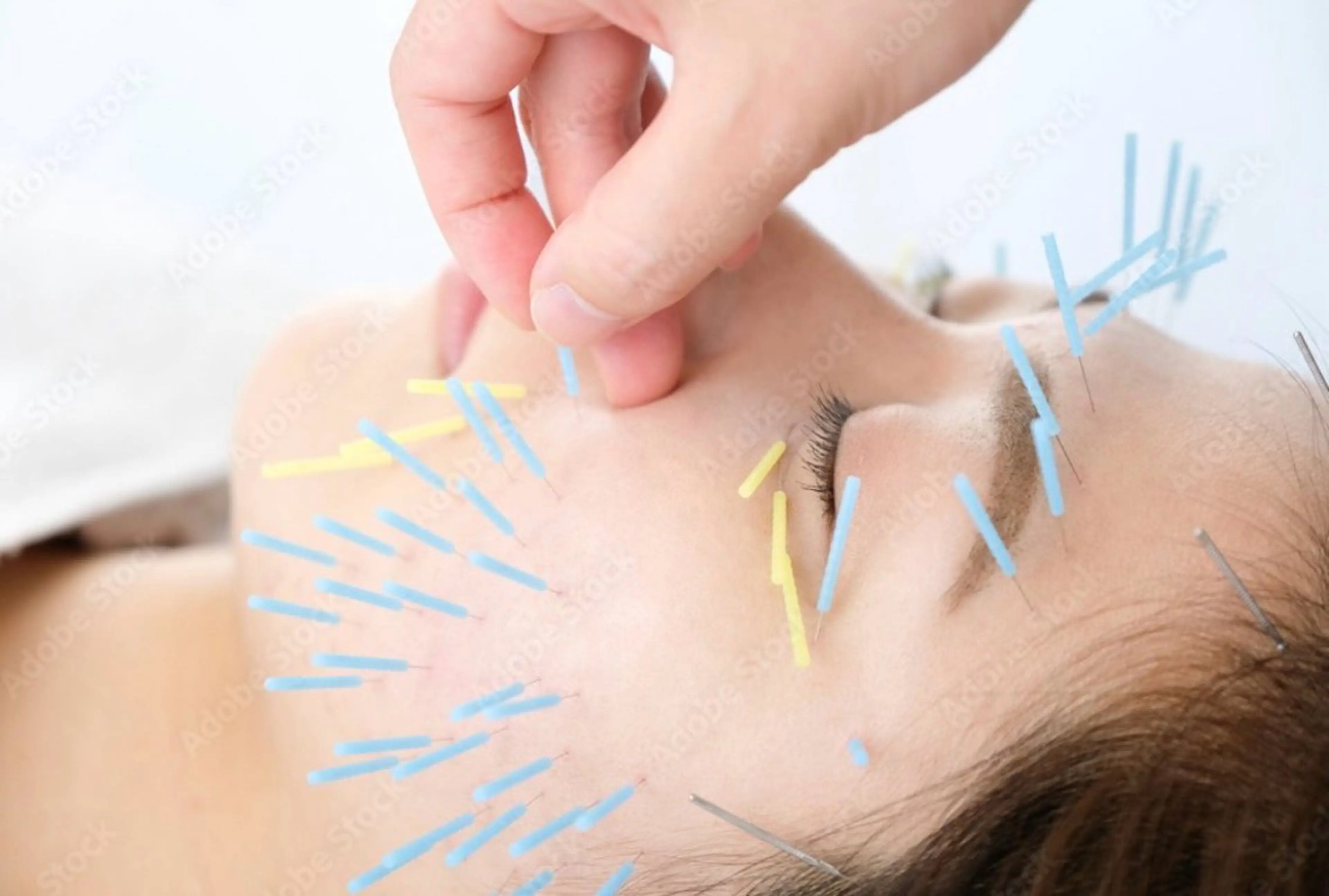 MK鍼灸整骨院　堀江店所属・小顔/美容鍼/整体 MITSUKIのその他イメージ