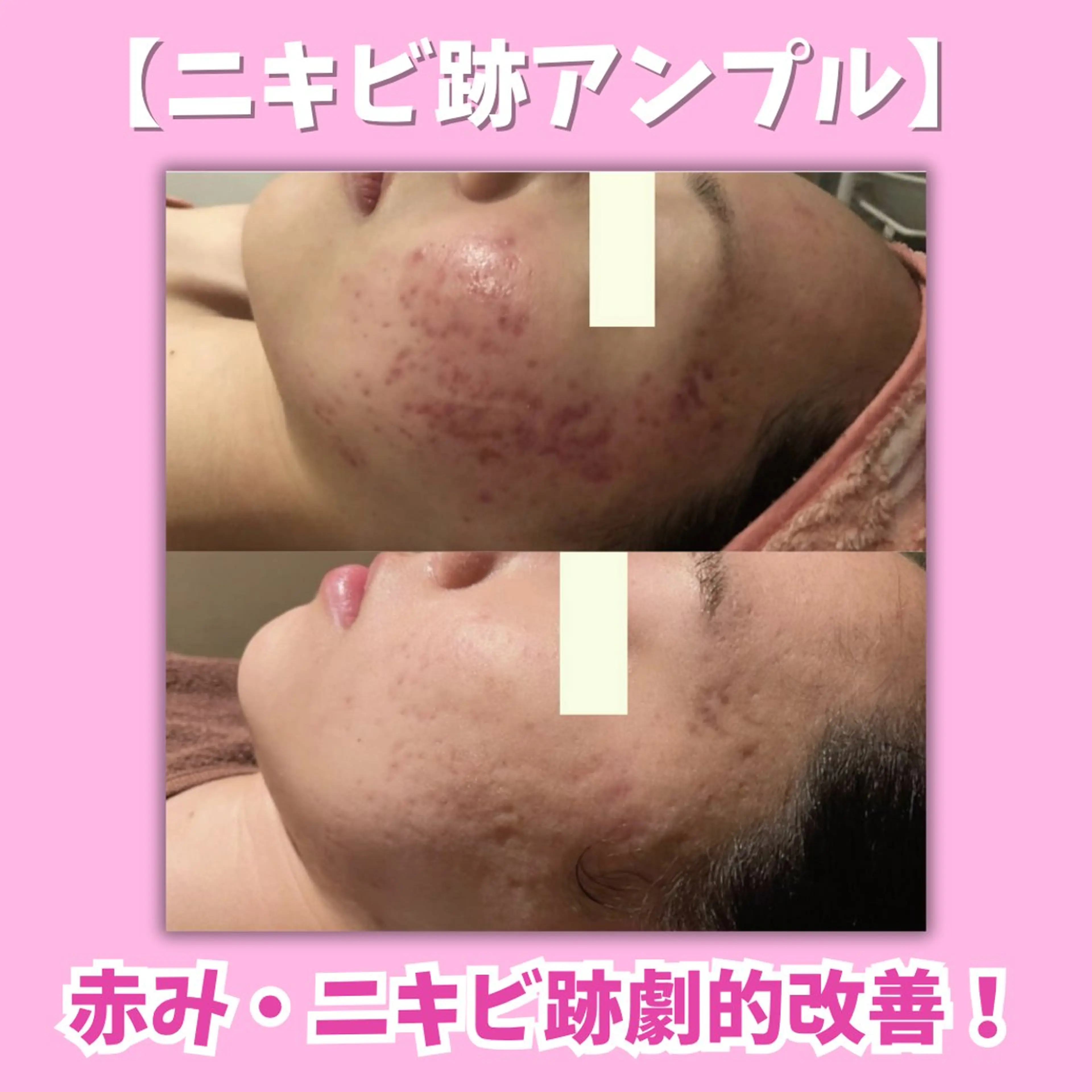 【赤み・ニキビ跡にお悩みの方へ👩⚕️✨】ニキビ跡アンプル×ソノフォレーシス導入で美肌革命💎の写真