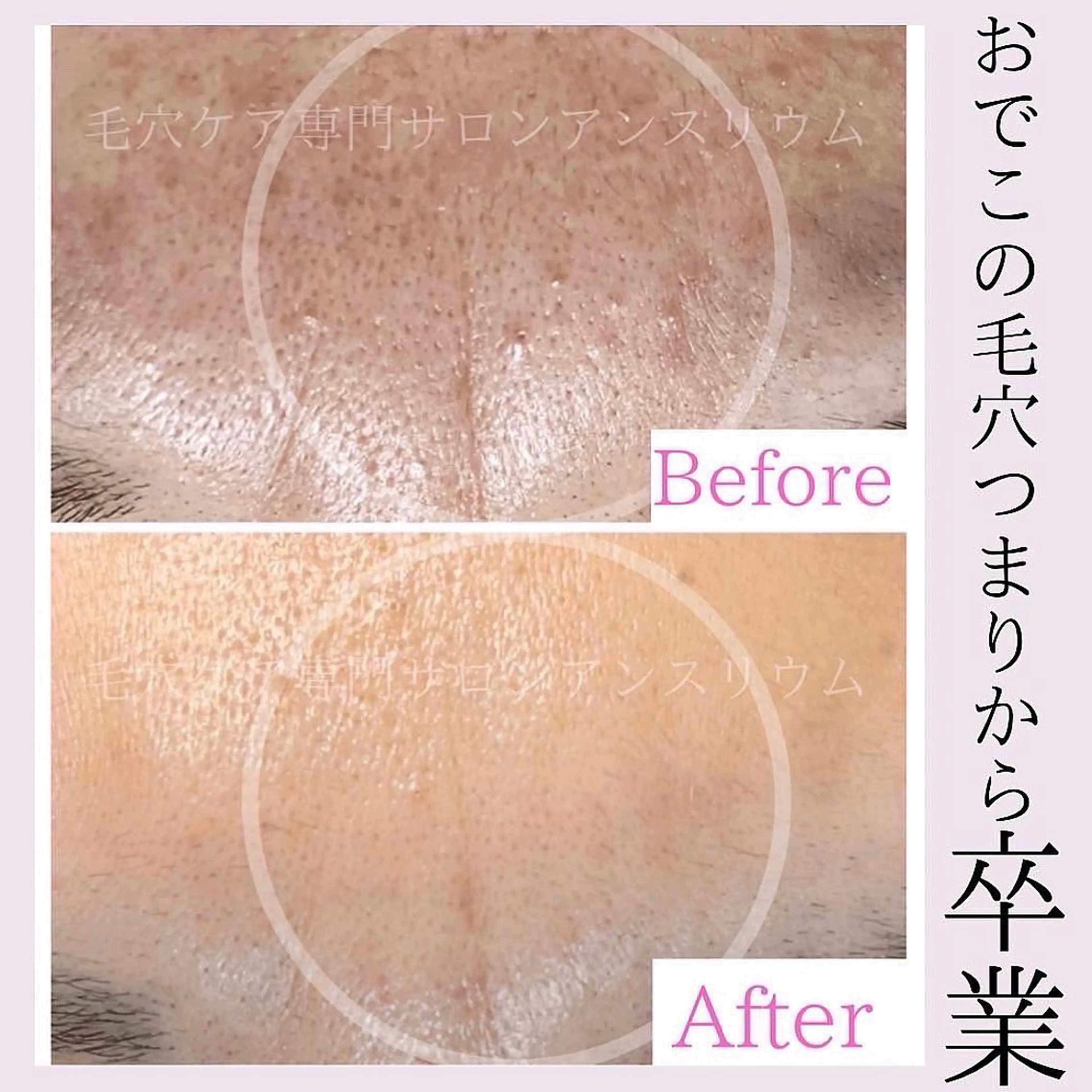 毛穴ケア専門サロンアンスリウム所属・茨城土浦 つくば毛穴 ケア専門サロンのエステ・リラクイメージ