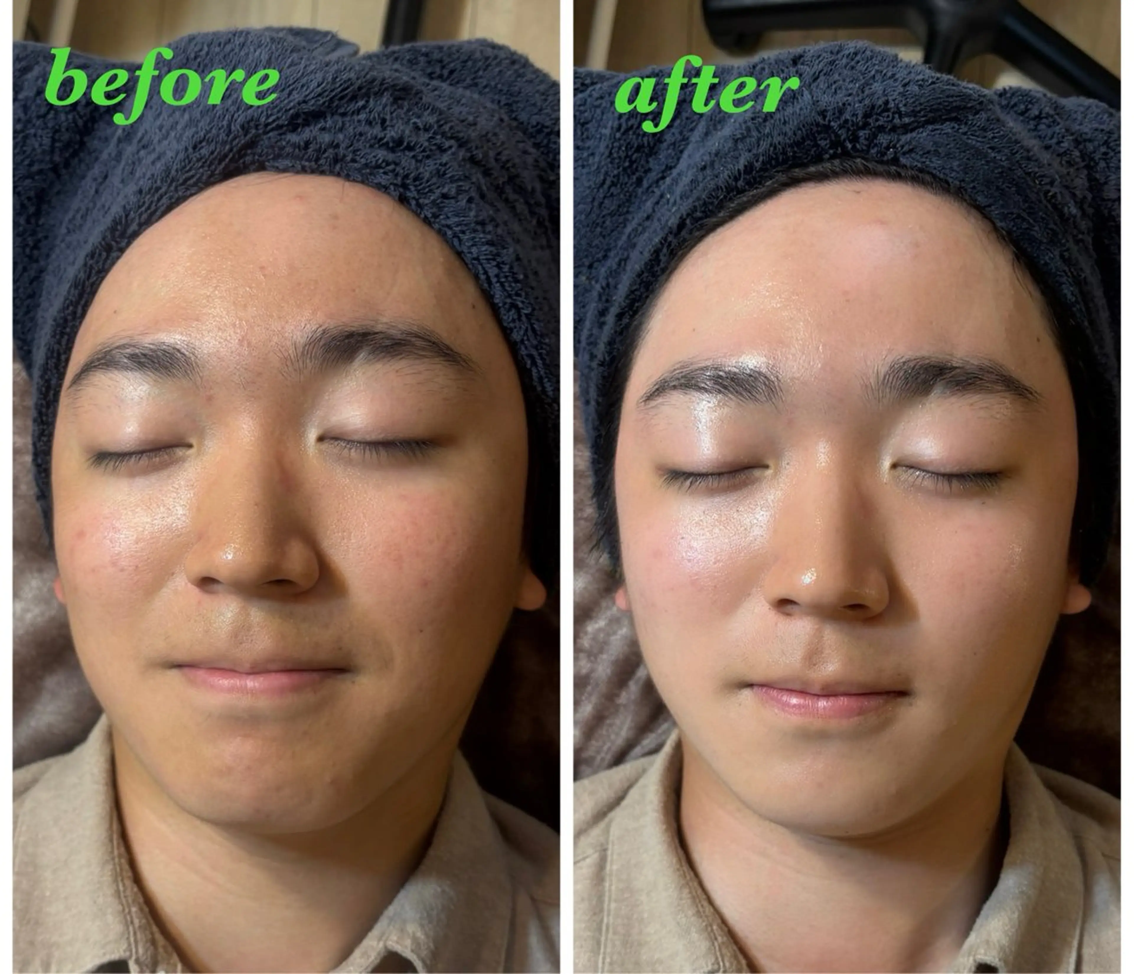 エステ ハーブピーリング/韓国肌管理/フェイシャル/毛穴洗浄/眉毛/顔脱毛【糸脱毛専門】rev所属・ハーブピーリング専門 毛穴洗浄❤️眉waxのエステ・リラクイメージ