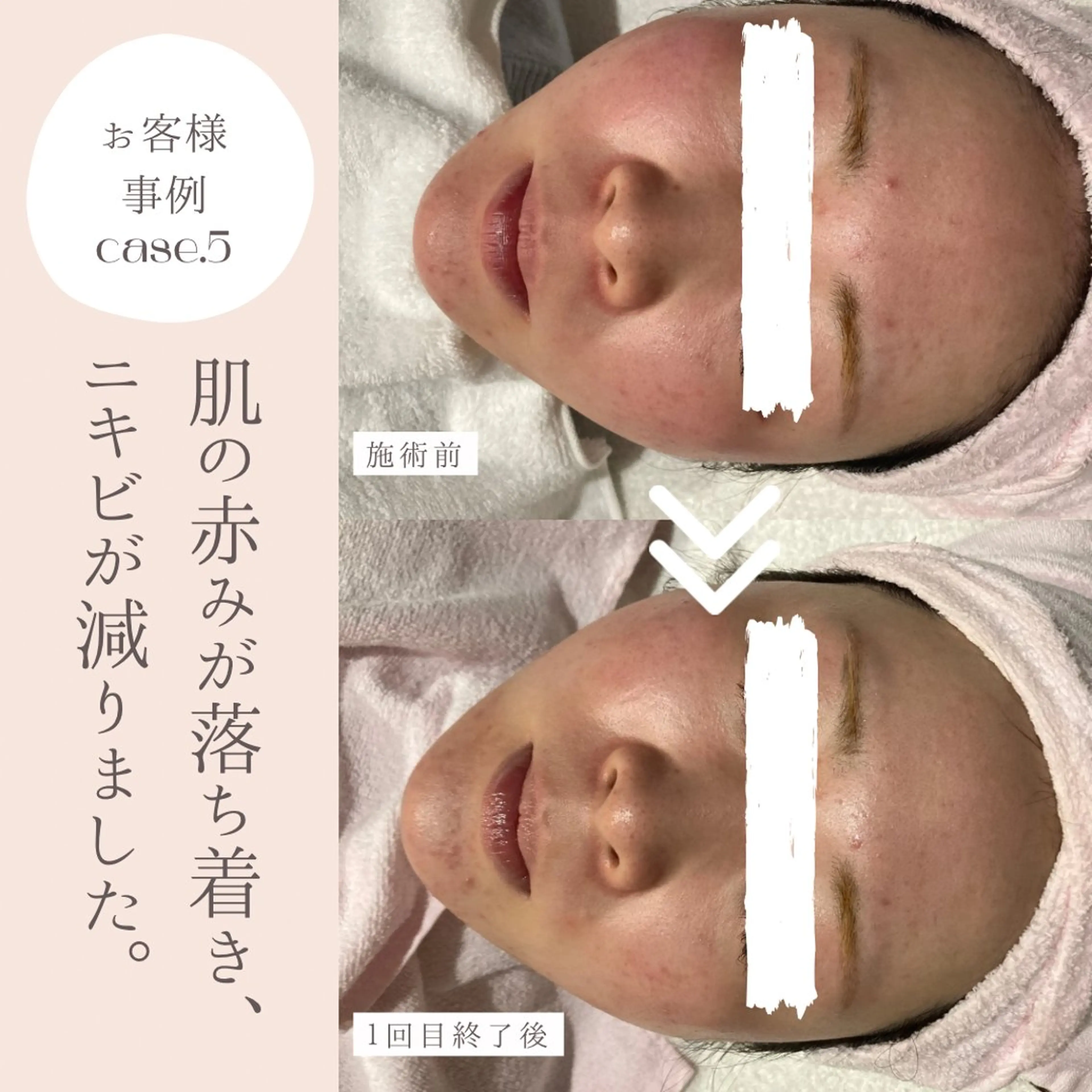 和漢よもぎ蒸しとフェイシャルのお店　maison de beaute所属・よもぎ蒸し/ 大人ニキビ　mamiのエステ・リラクイメージ