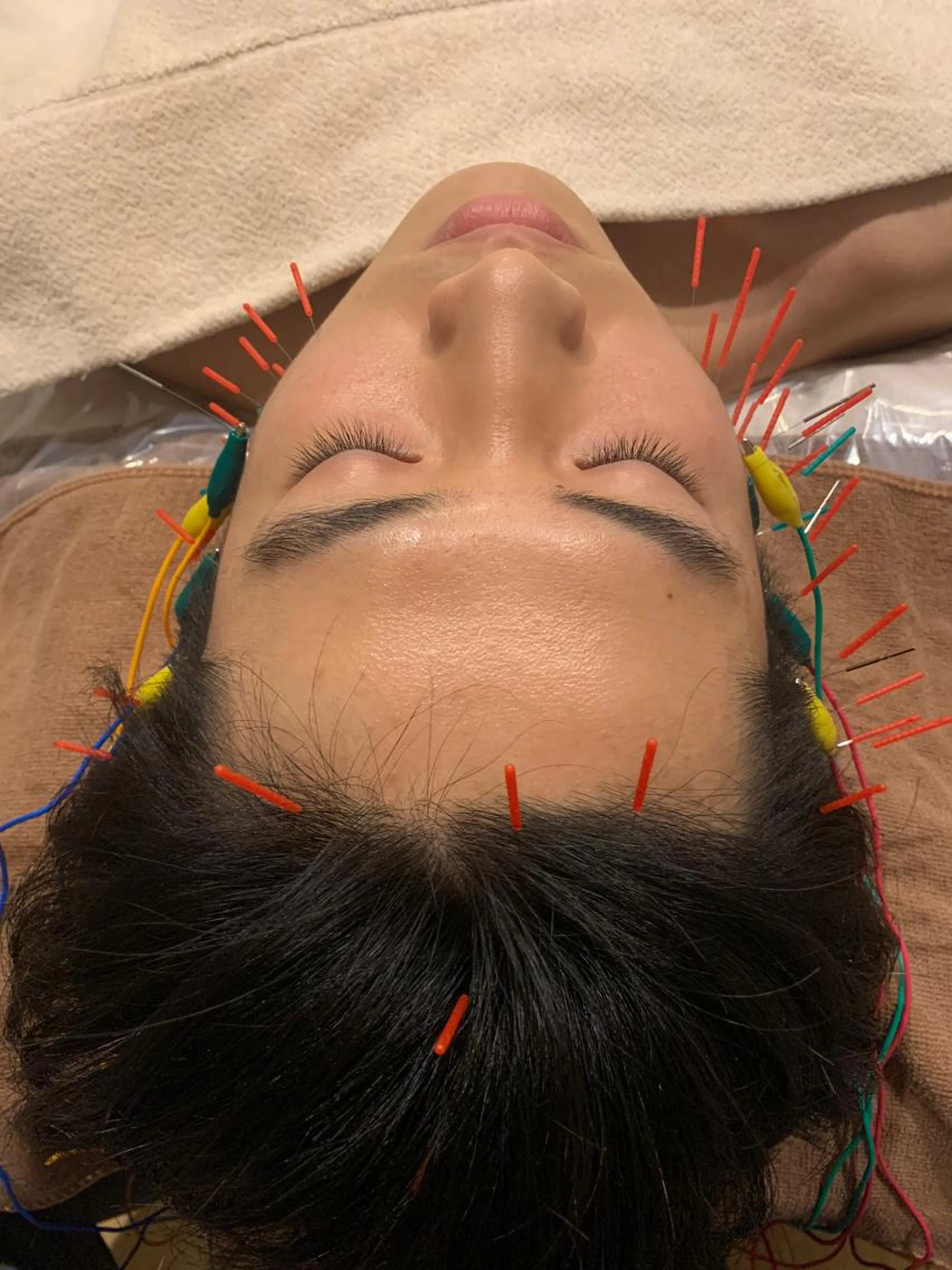 🔥人気急上昇メニュー🔥メンズ美容鍼🪡の写真