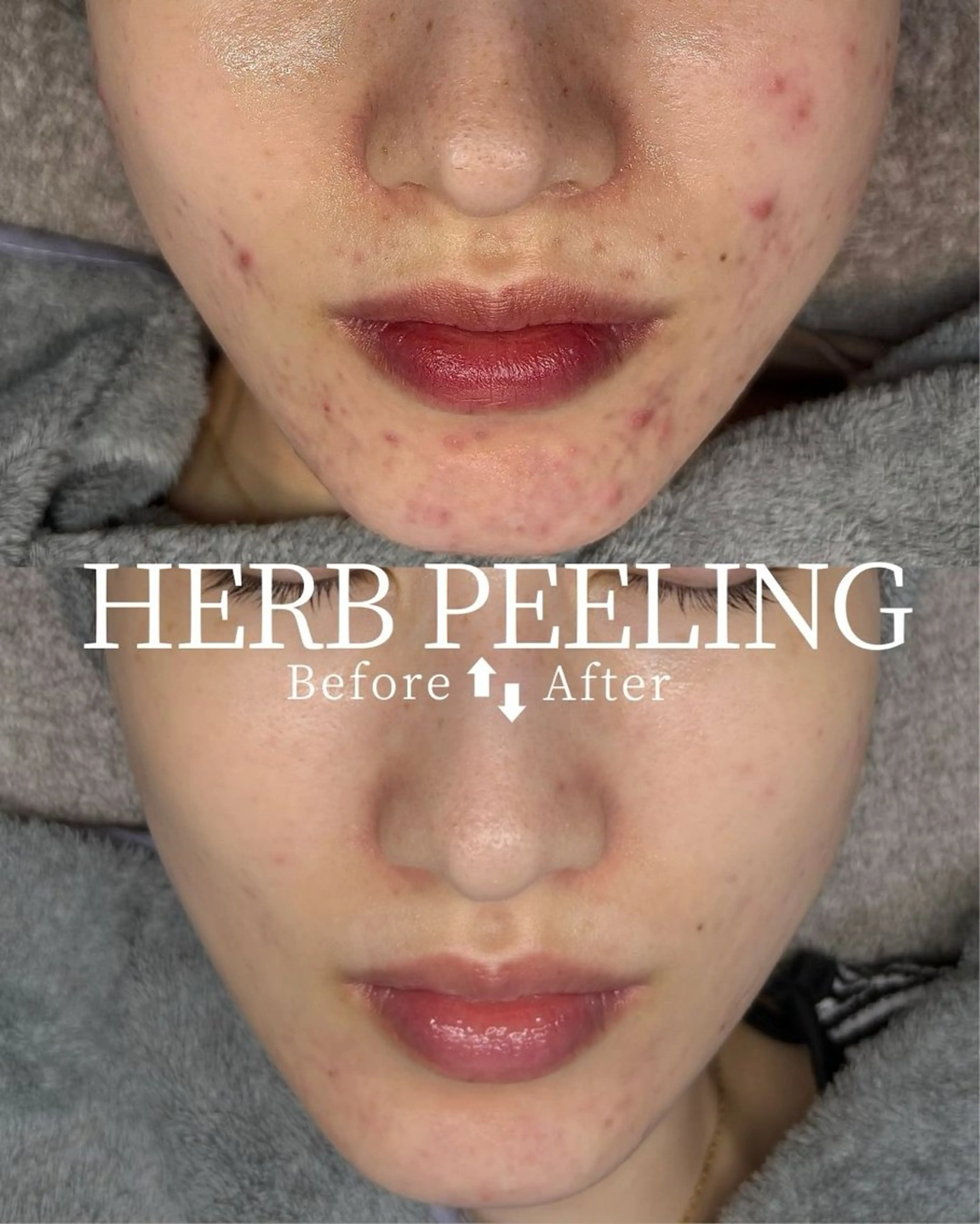 韓国発iLLONハーブピーリング＋肌診断(剥離あり/なし選択可)の写真