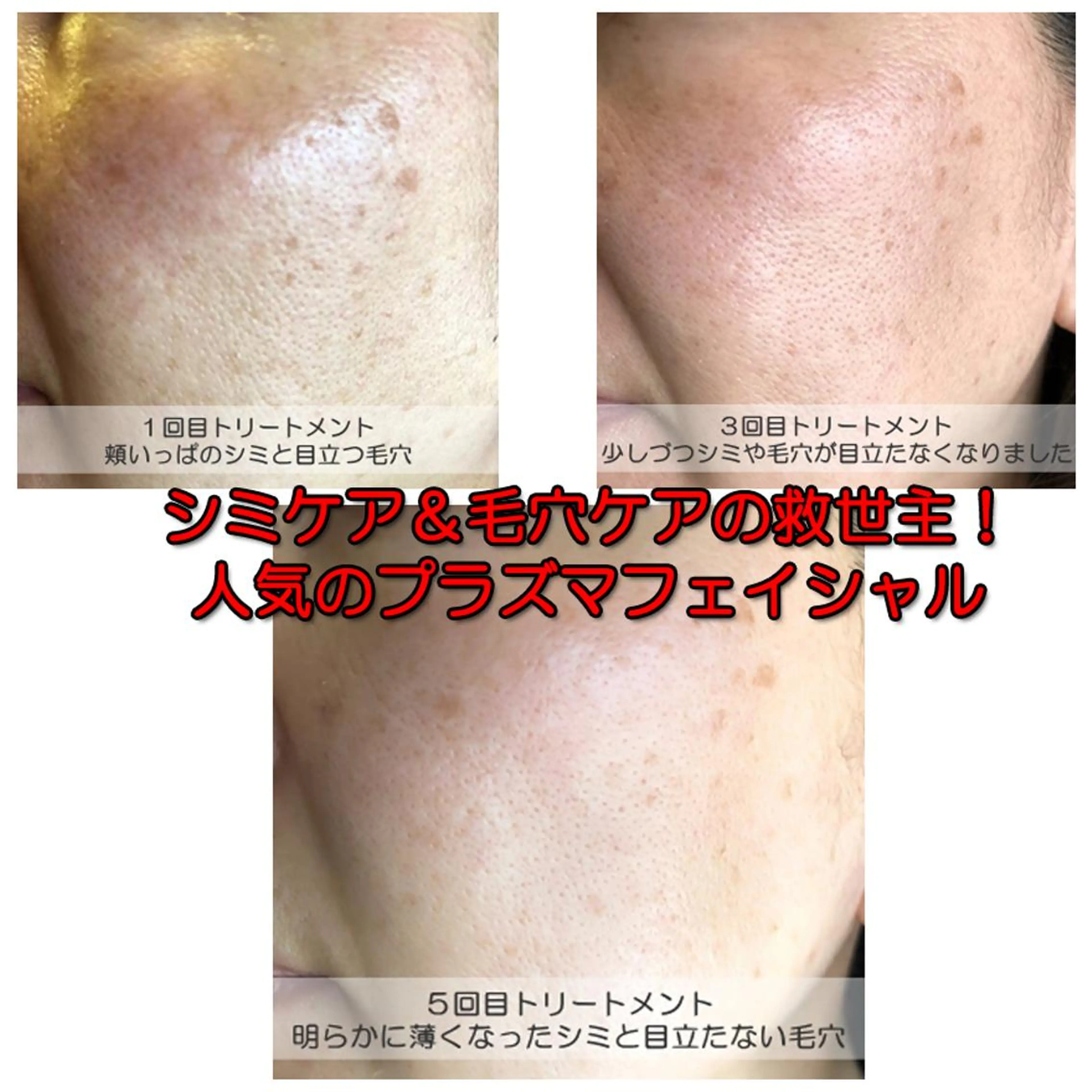 【ミニモ限定価格】『美白&透明感あるキメ艶肌』の救世主✨30分×1回の写真