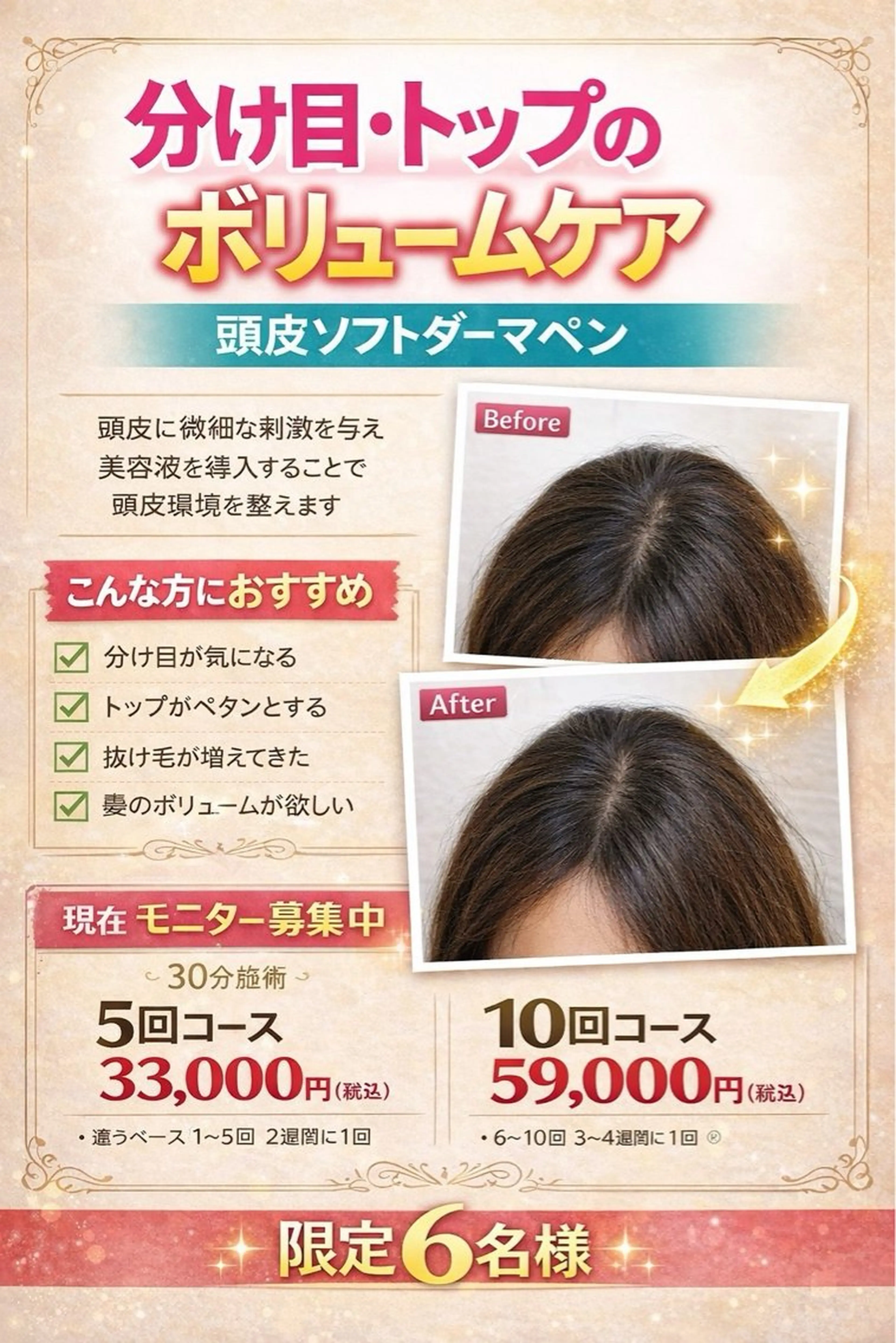 【Newコース】頭皮ソフトダーマペン✨分け目・トップふんわり復活🌿初回4,400円の写真