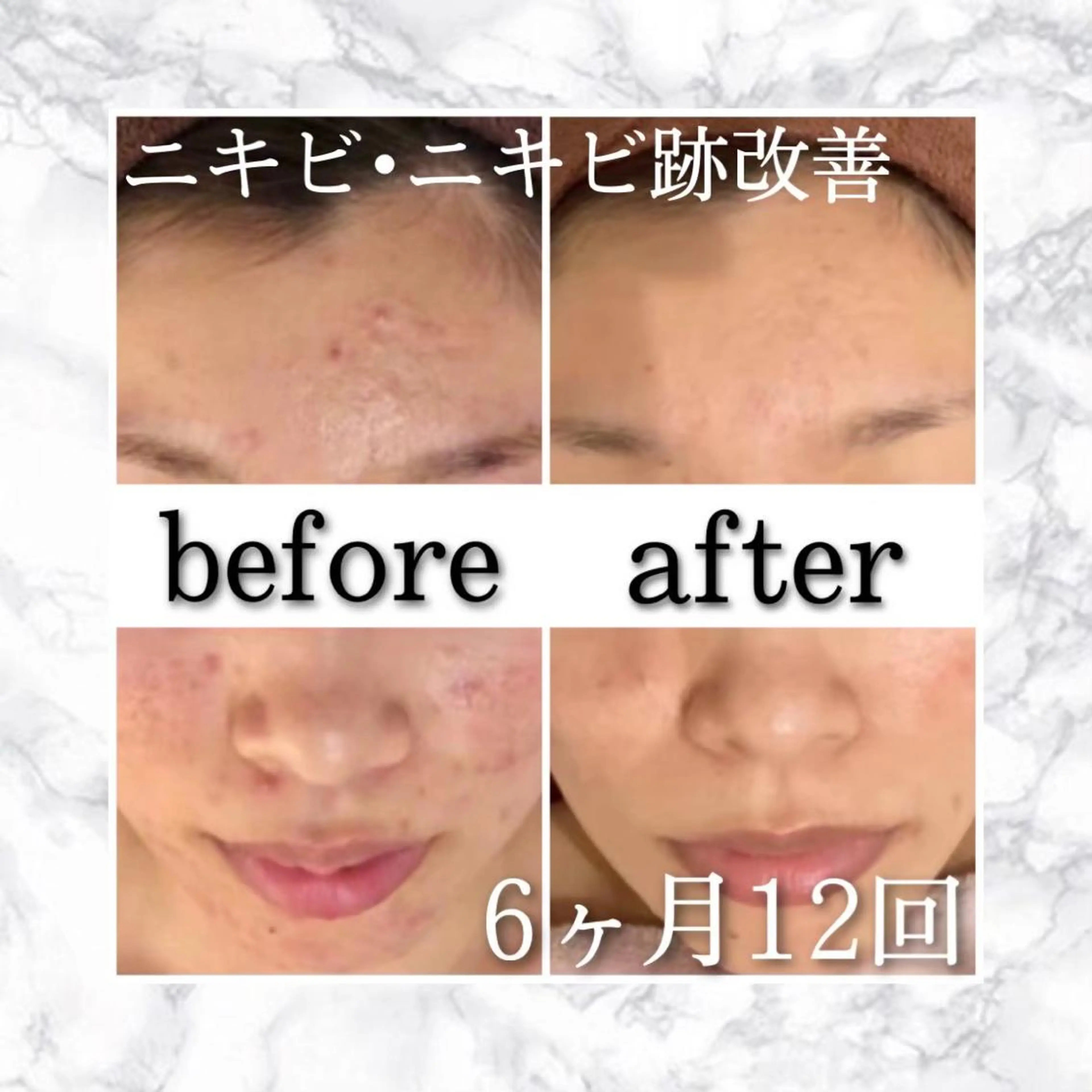 セミロング カラー パーマ ヘアアレンジ メンズ キッズ ネイル マツエク・マツパ アイブロウ エステ リラク ニキビ特化型エステ 🍓最短で肌質改善のエステ・リラクイメージ