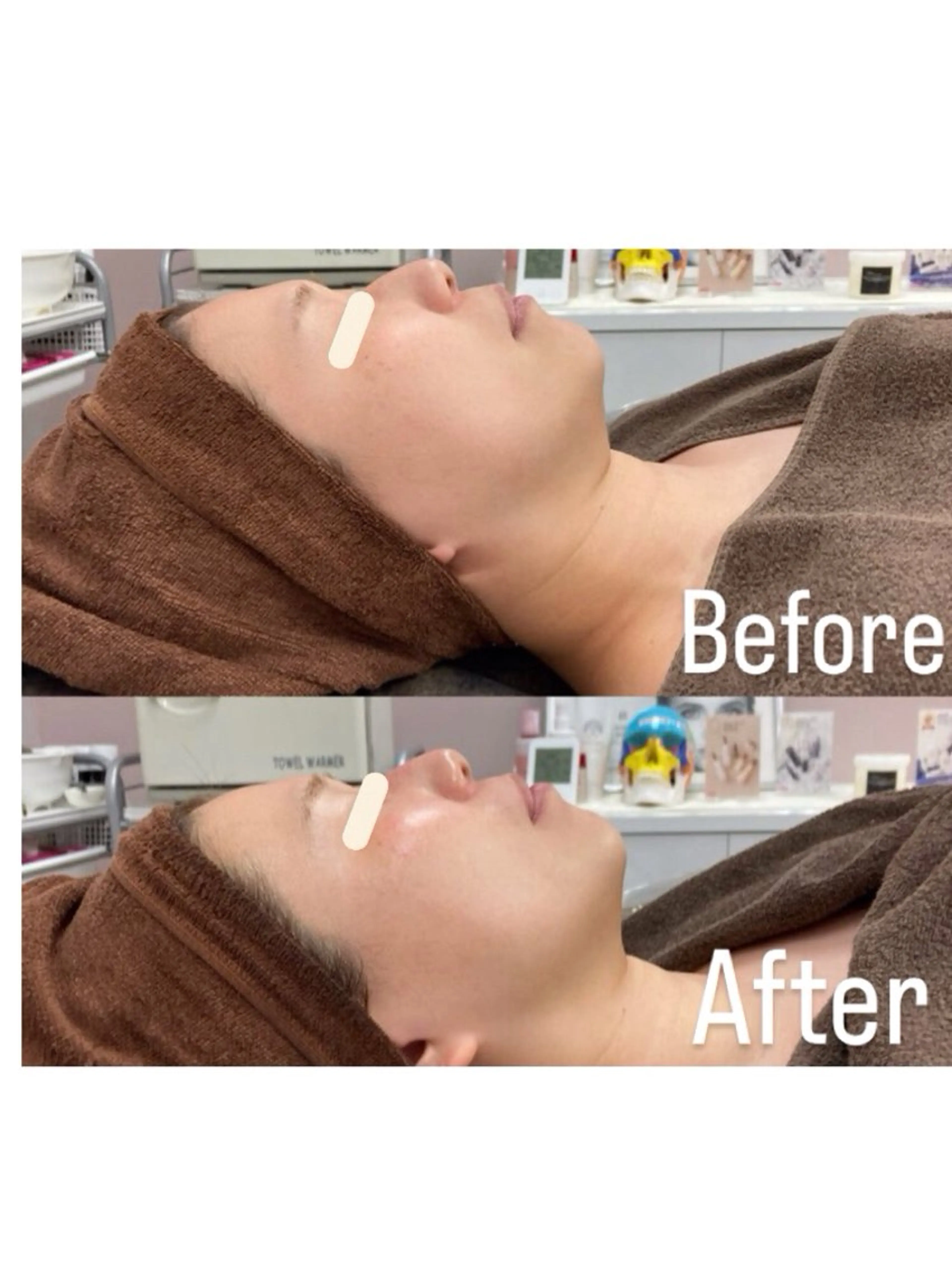 《美白/ハリツヤ/繰り返す肌トラブル》水分爆弾トリートメント【リアボーテ　マーメイドセルトリートメント】の写真