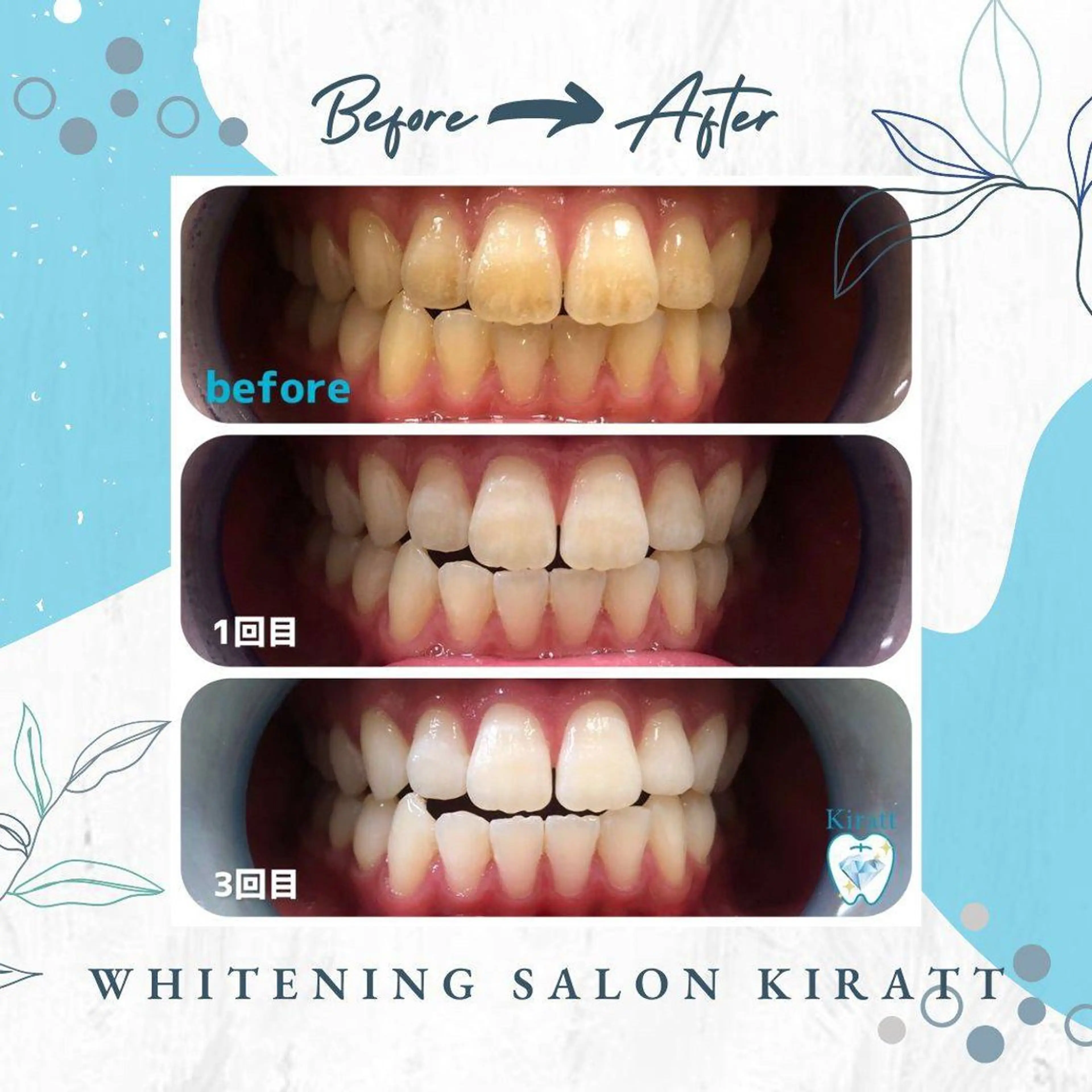 セルフホワイトニングサロンKiratt札幌店💎所属・Kiratt 札幌店のその他イメージ