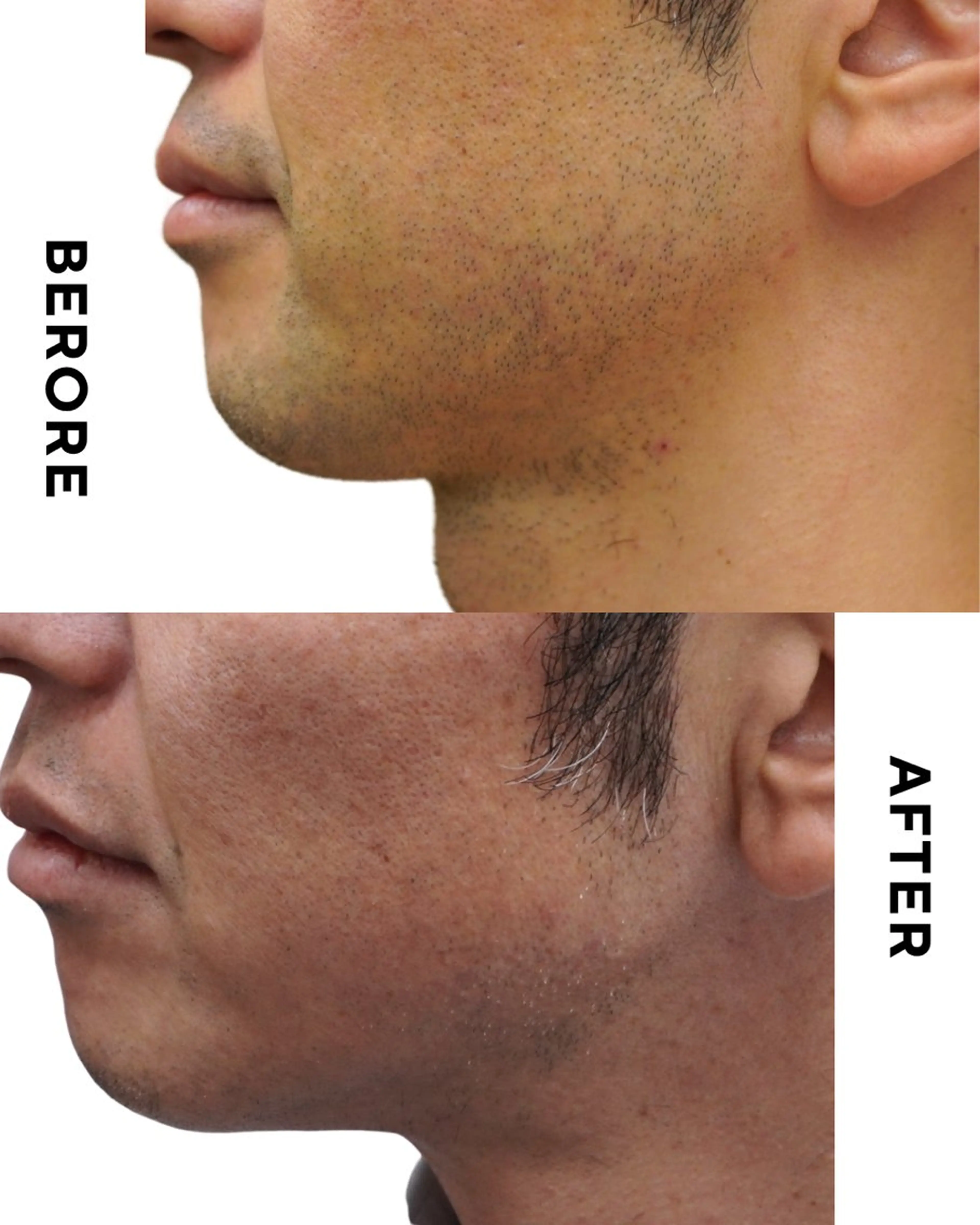 【メンズ】ヒゲ脱毛の写真