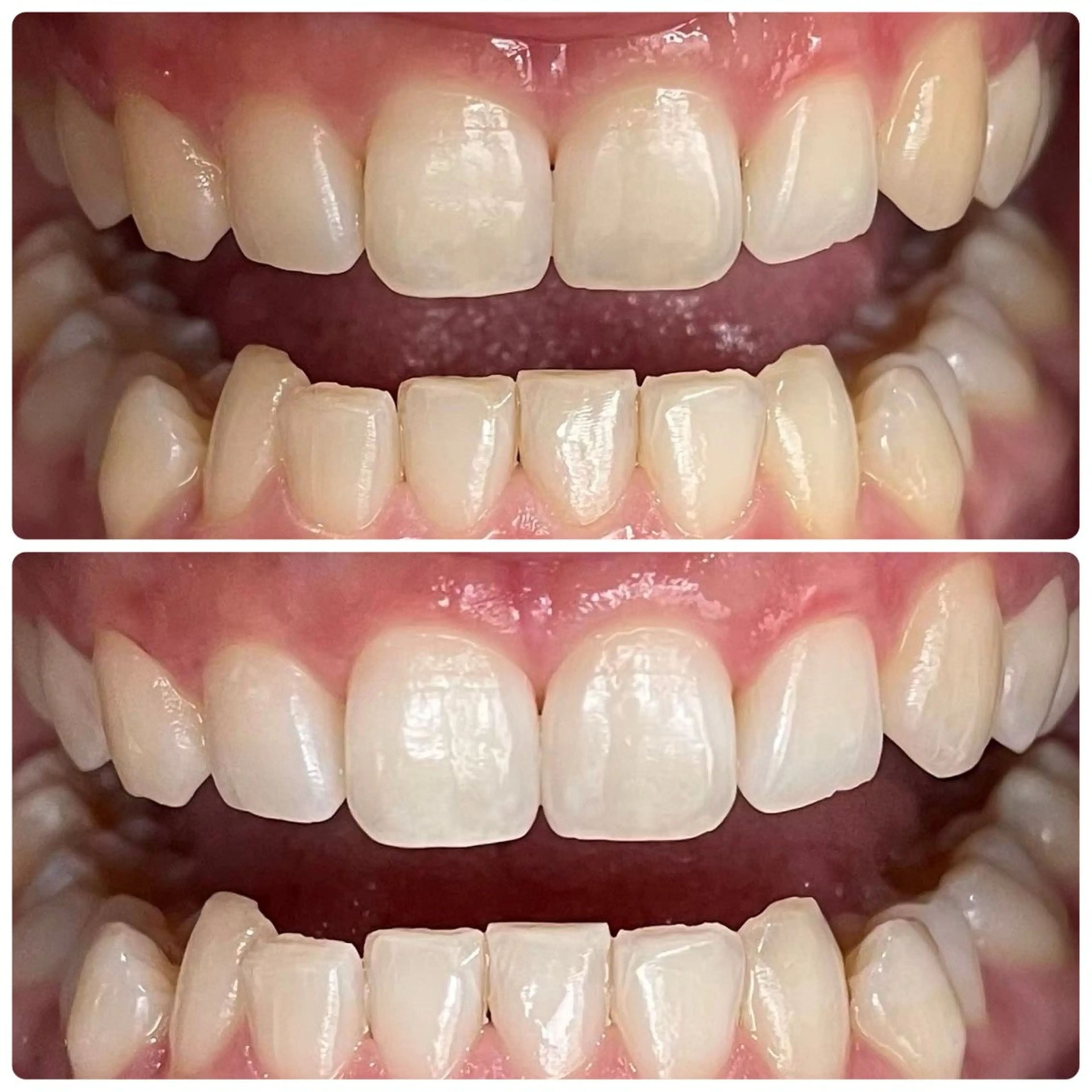 【期間限定👀】歯の黄ばみにホワイトニング体験メニュー🦷8分×3回で効果実感✨セルフで簡単本格ケア💎の写真