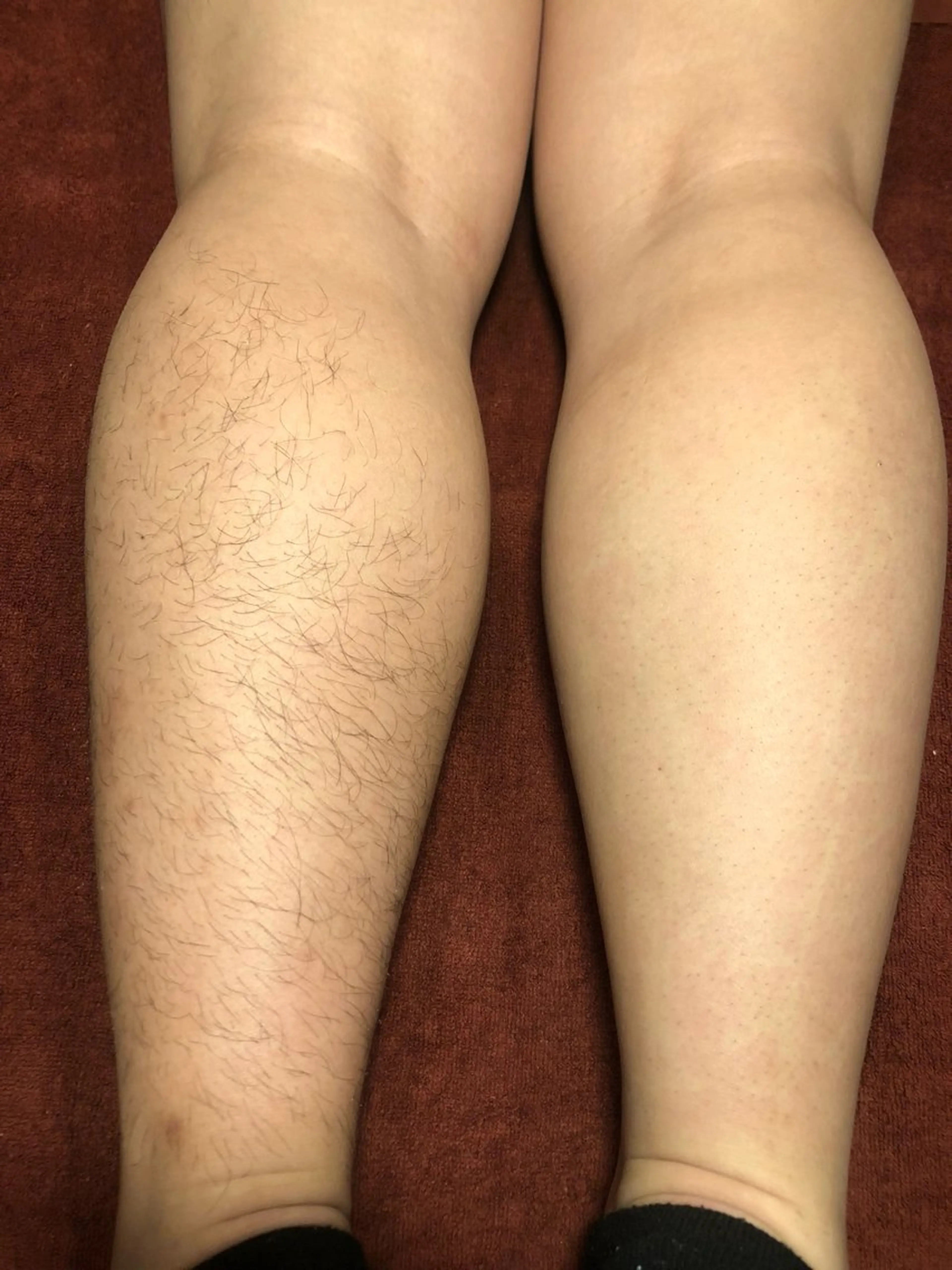 【メンズ限定】脚脱毛の写真