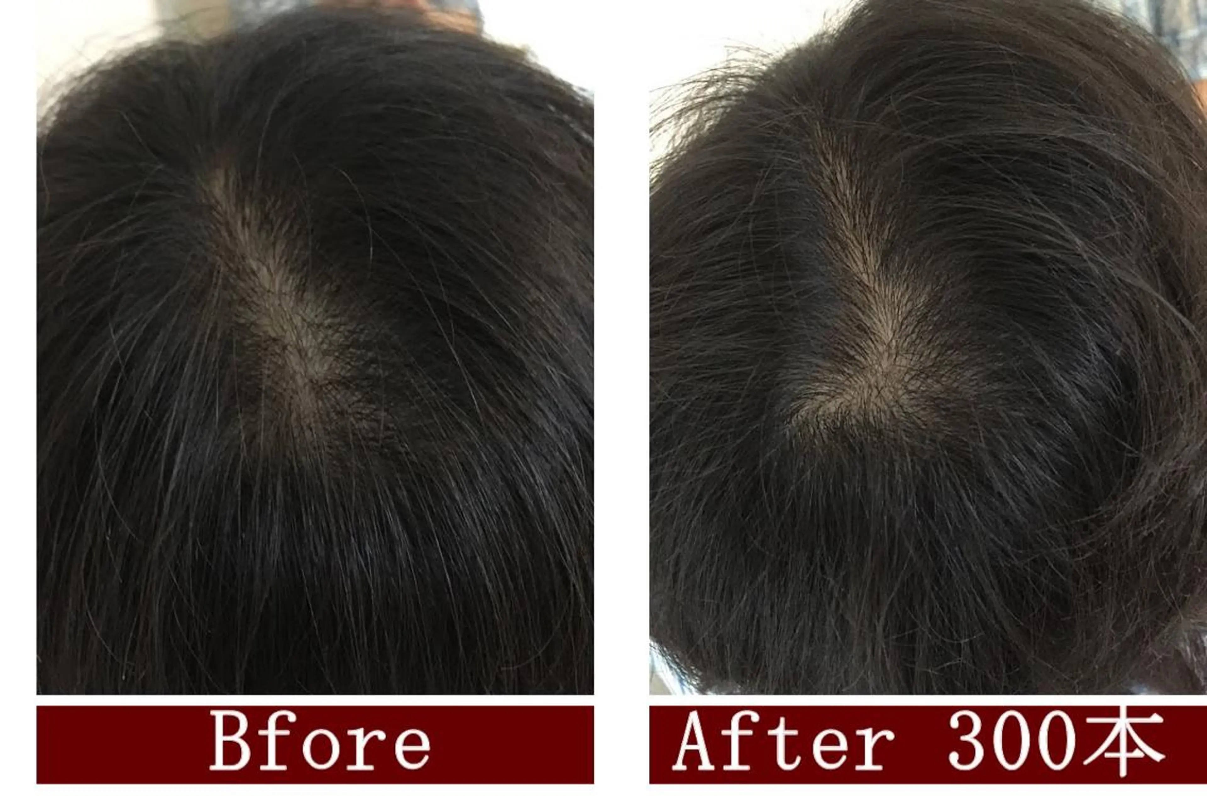 ヘアーループ増毛　３００本の写真