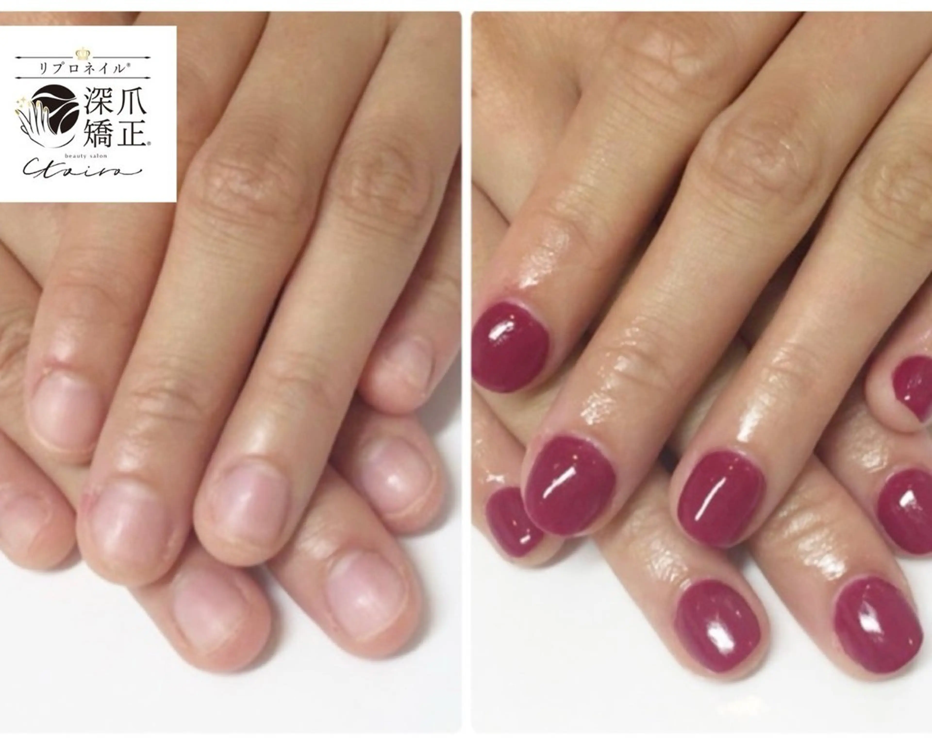 メンズ ネイル フットネイル 深爪矯正専門店　ネイルサロン　トイロ所属・ネイルサロン トイロのネイルデザイン