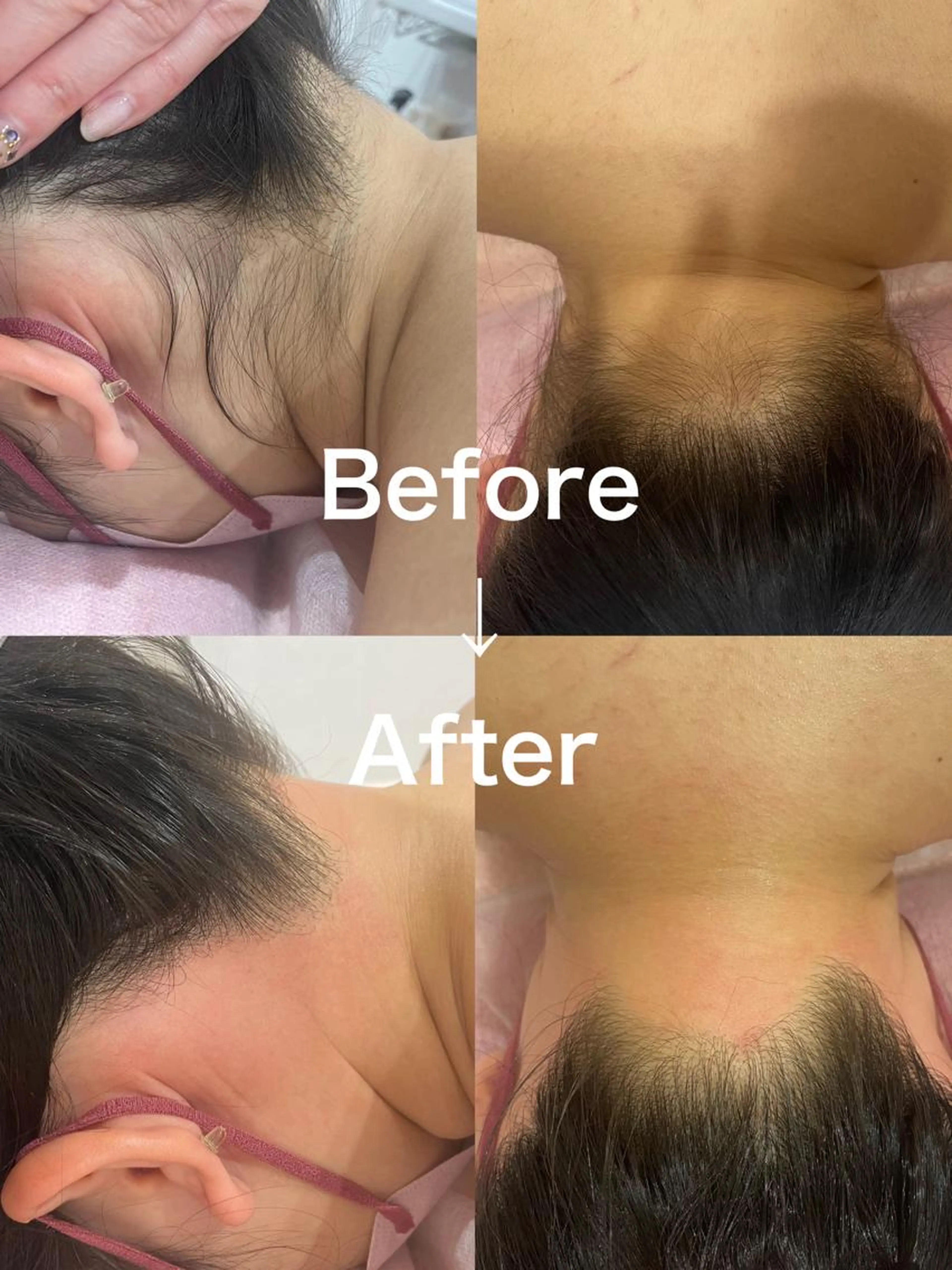 【期間限定】うなじワックス脱毛🌸卒業式のアップスタイルに👘の写真