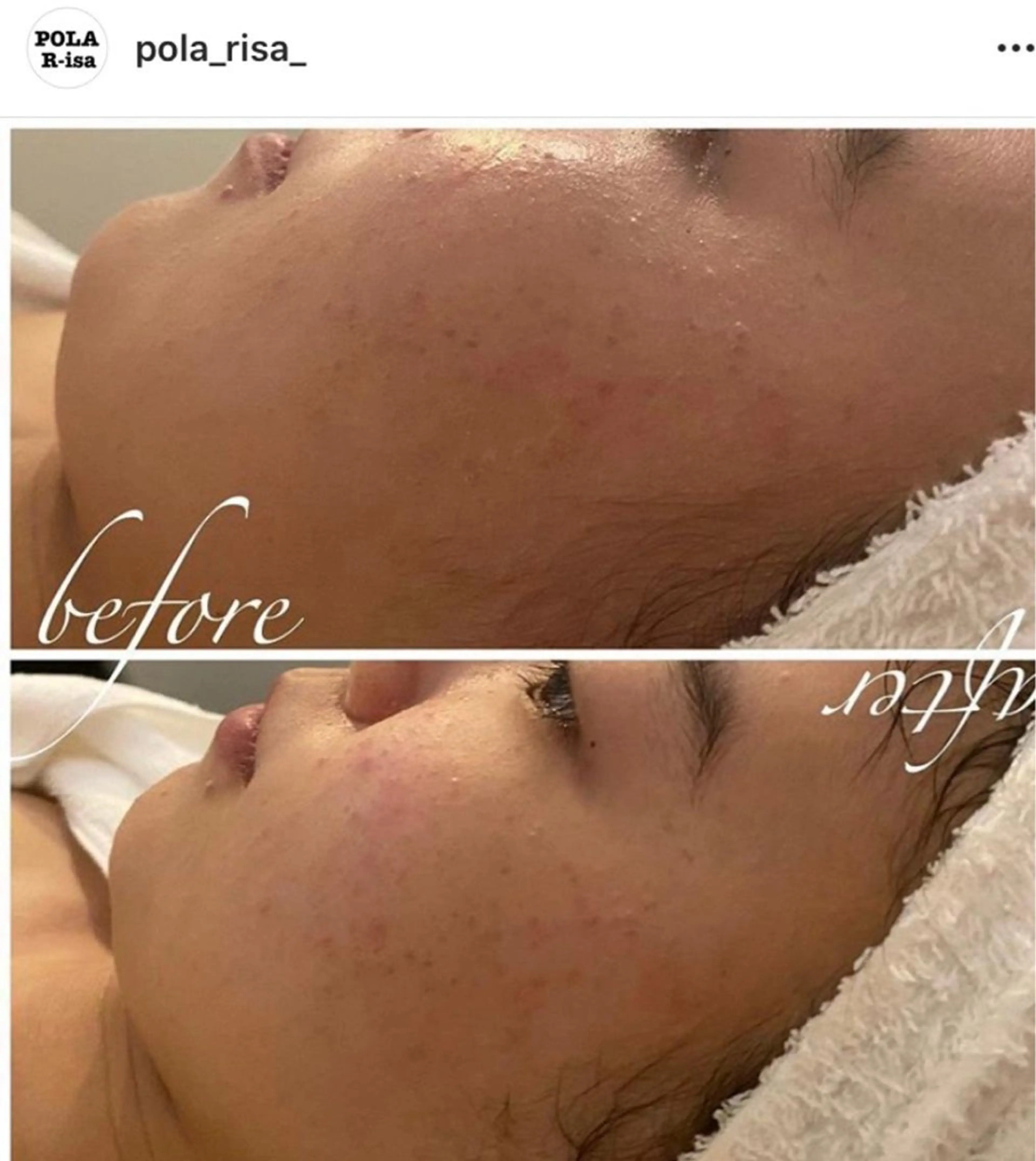 【当店が初めての方限定】毛穴クレンジング🪠🤍まずは毛穴ケアを体感したい方✨✨の写真