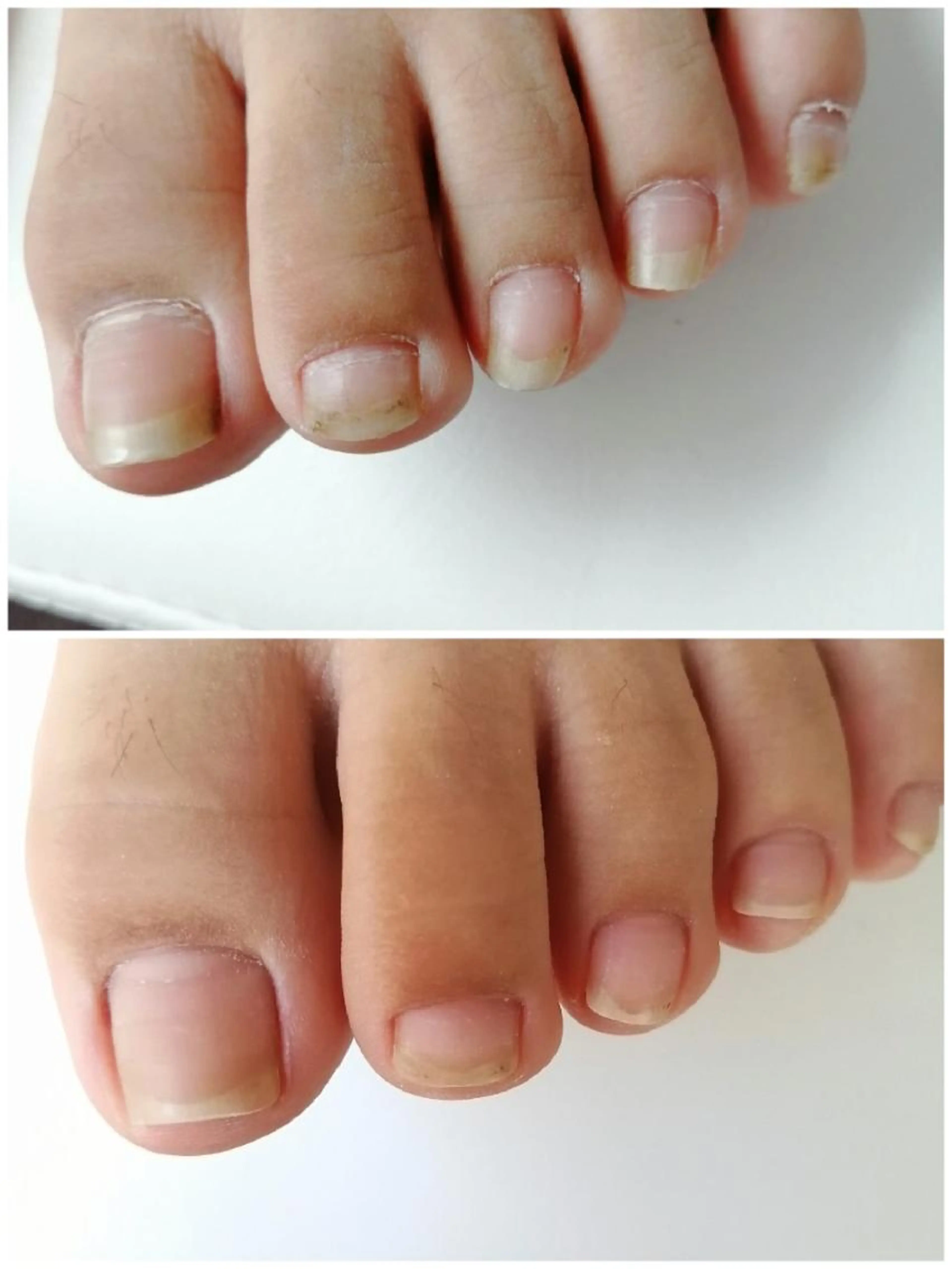 深爪、巻き爪でお悩みの方へ、足爪回りのお悩み解決！フットケアの写真