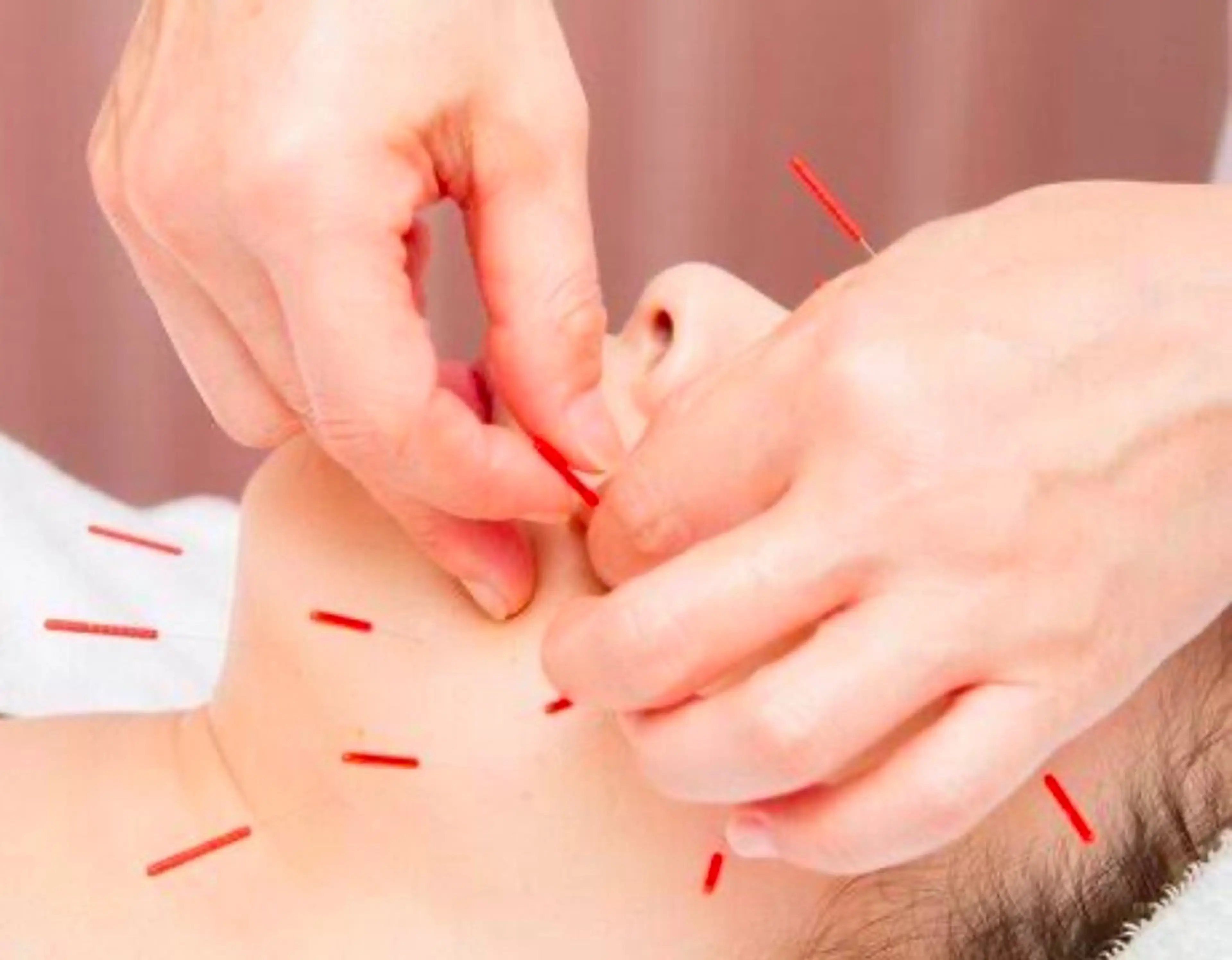 スタンダード美容鍼の写真