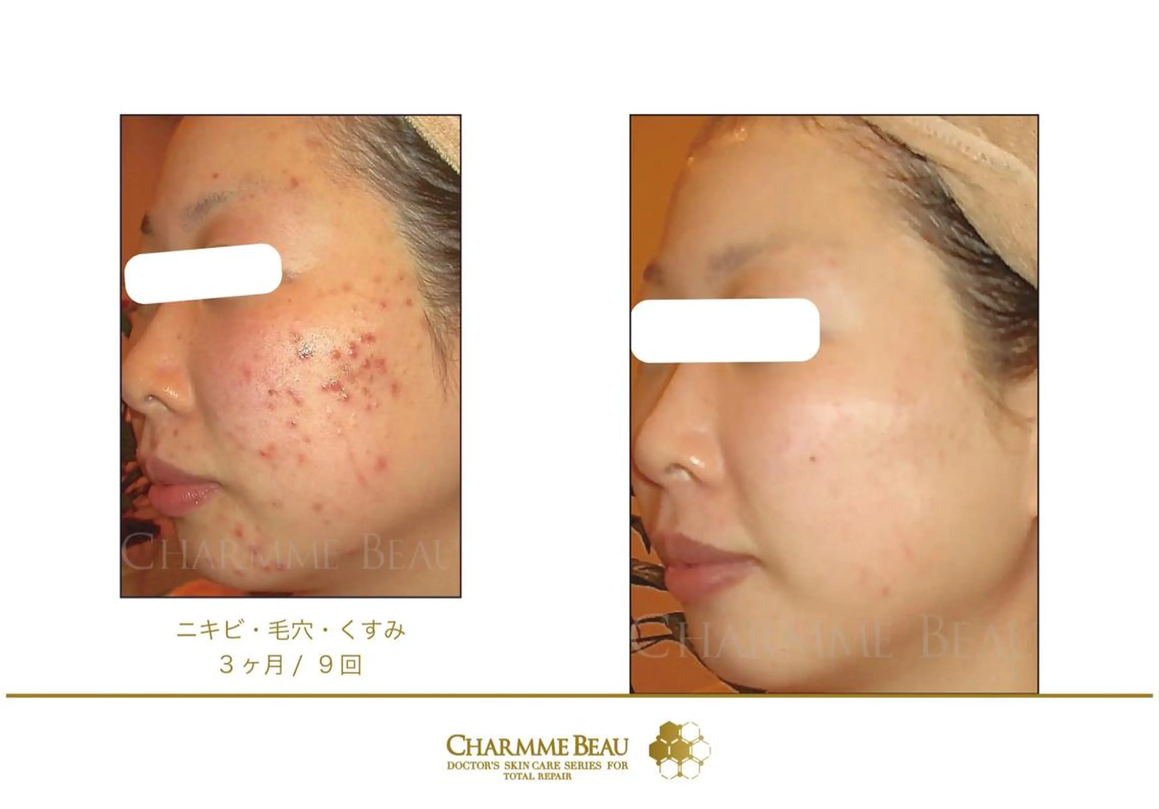 🔸赤く熟したニキビケアの写真