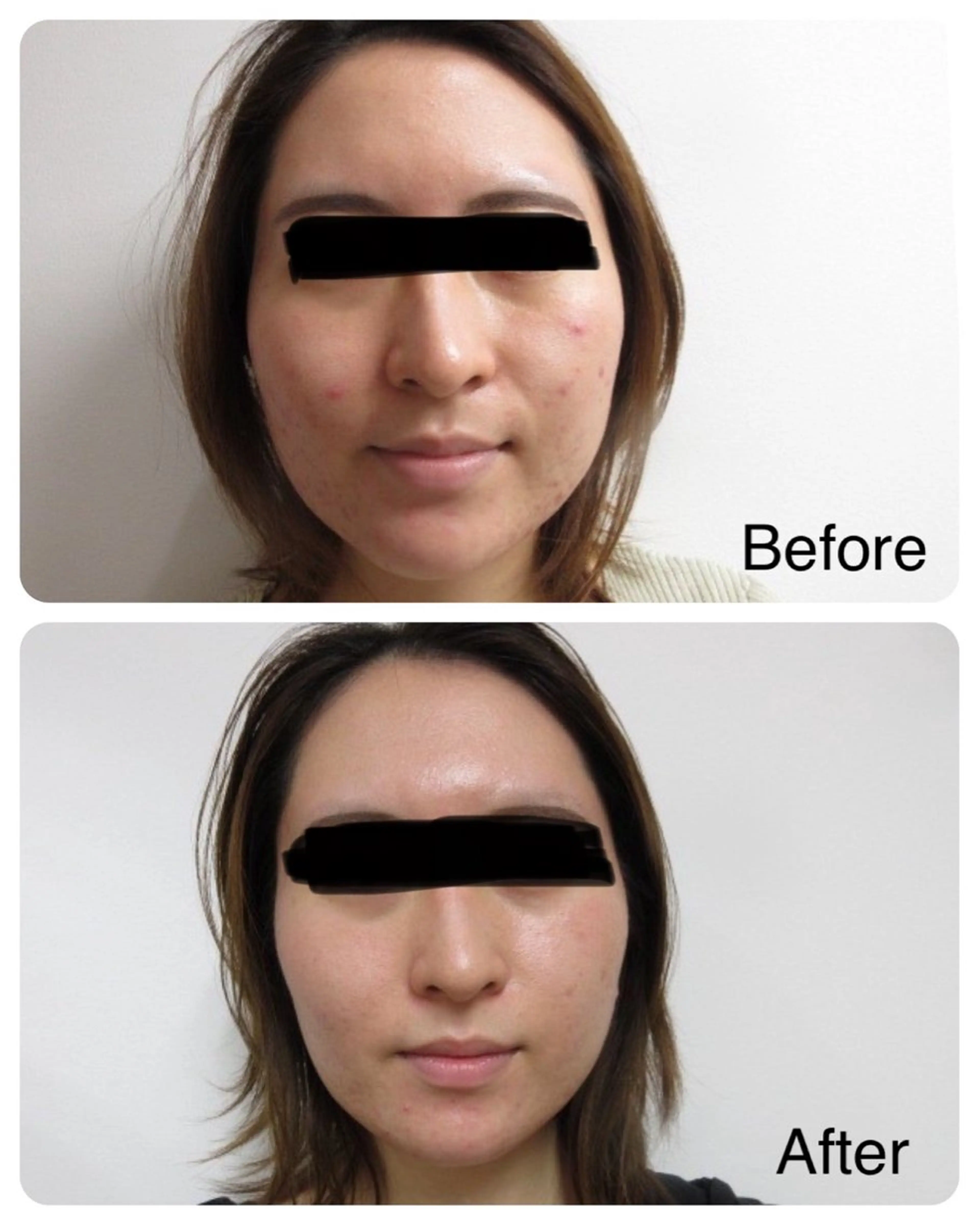 【赤ニキビ改善】 BELL'ET新宿店のエステ・リラクイメージ