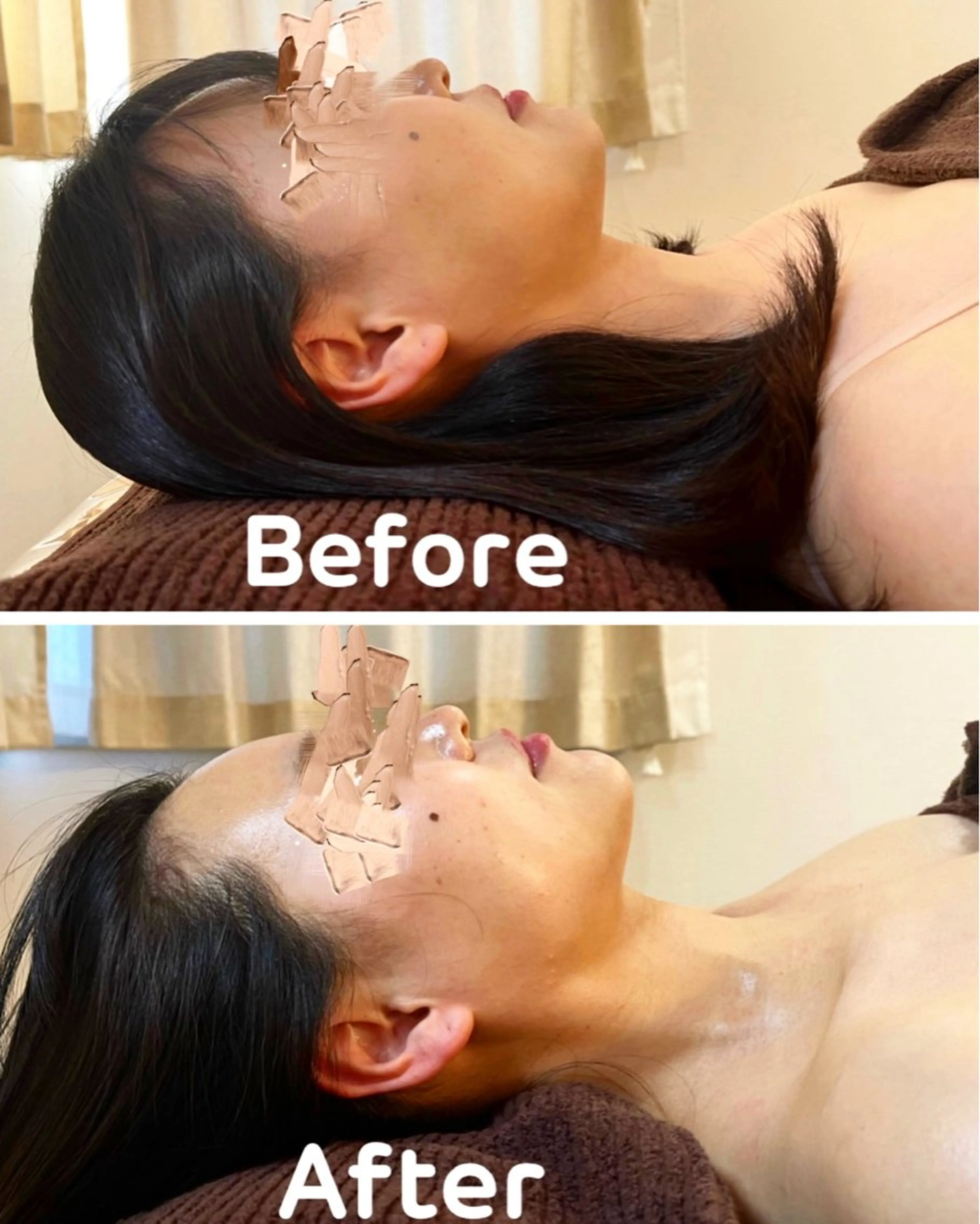 U25限定【モニター（女性）／小顔】小顔リフトでむくみやたるみ、二重顎を改善！ミニモ学割&25歳以下クーポンの写真