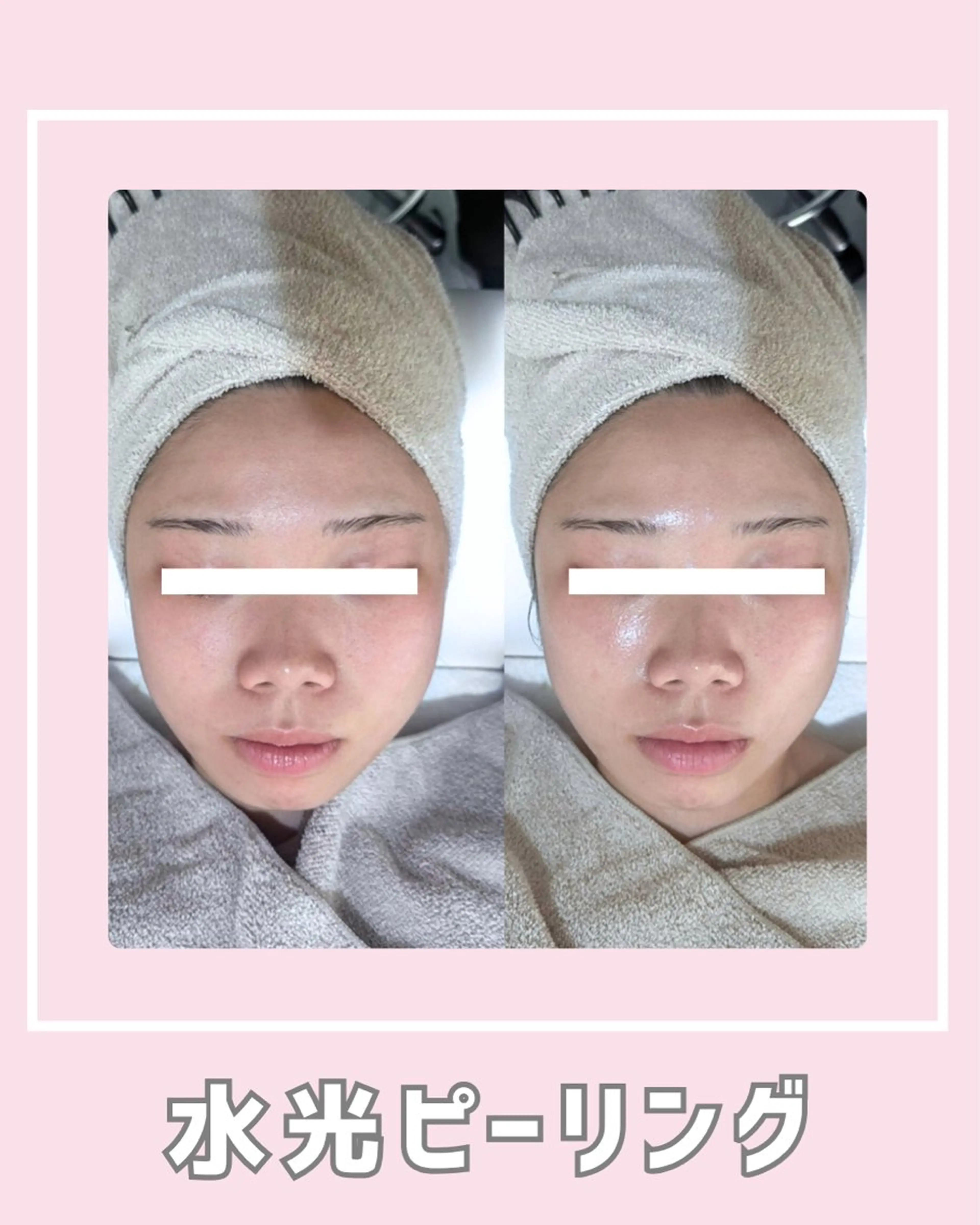 エステ |ピーリング・毛穴| soina神楽坂のエステ・リラクイメージ