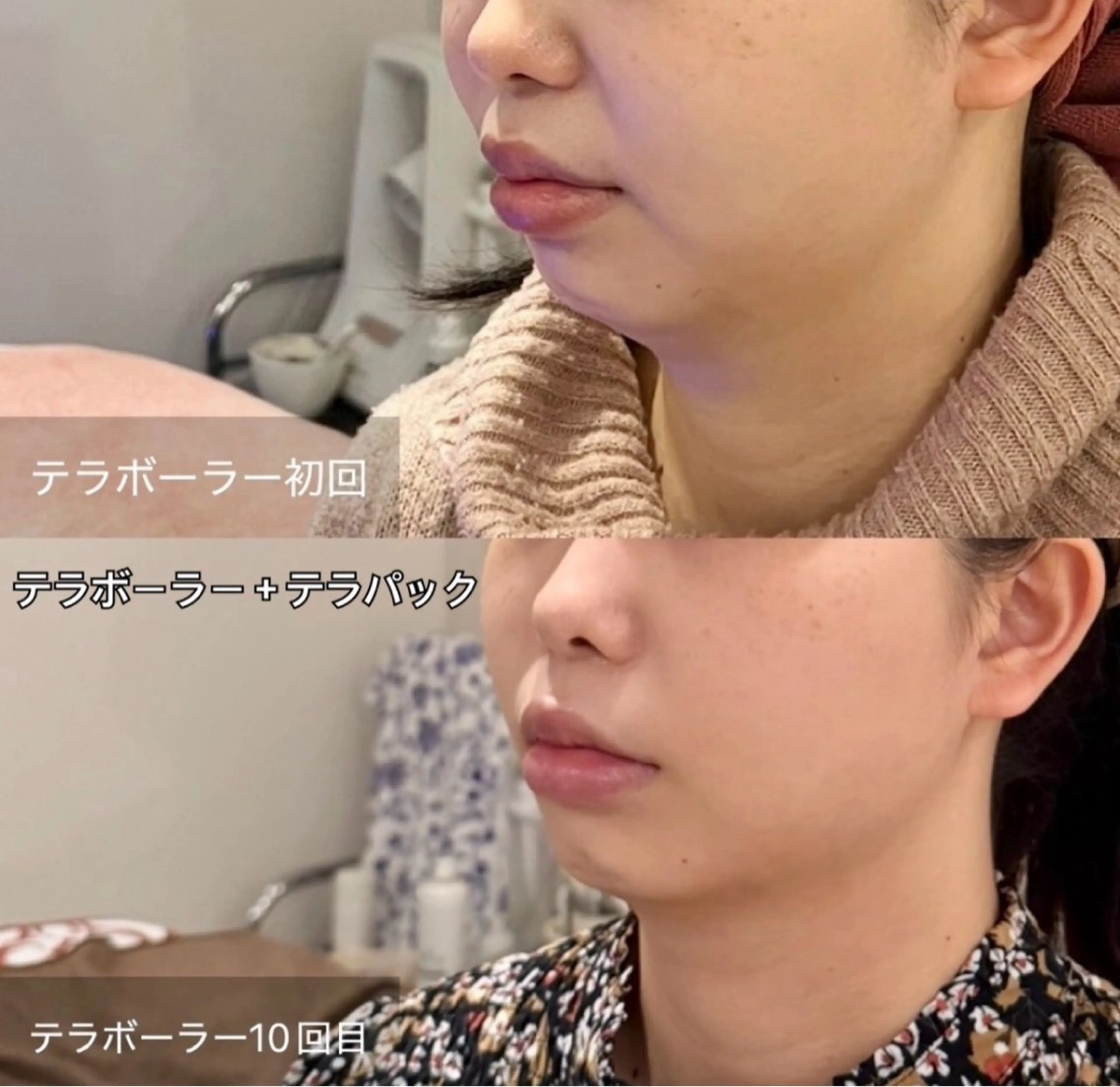 テラボーラー（表情筋ケア）電気刺激で普段使えていない筋肉をしっかりアプローチ✨✔ たるみケア✔ 引き締め✔ 血行促進の写真