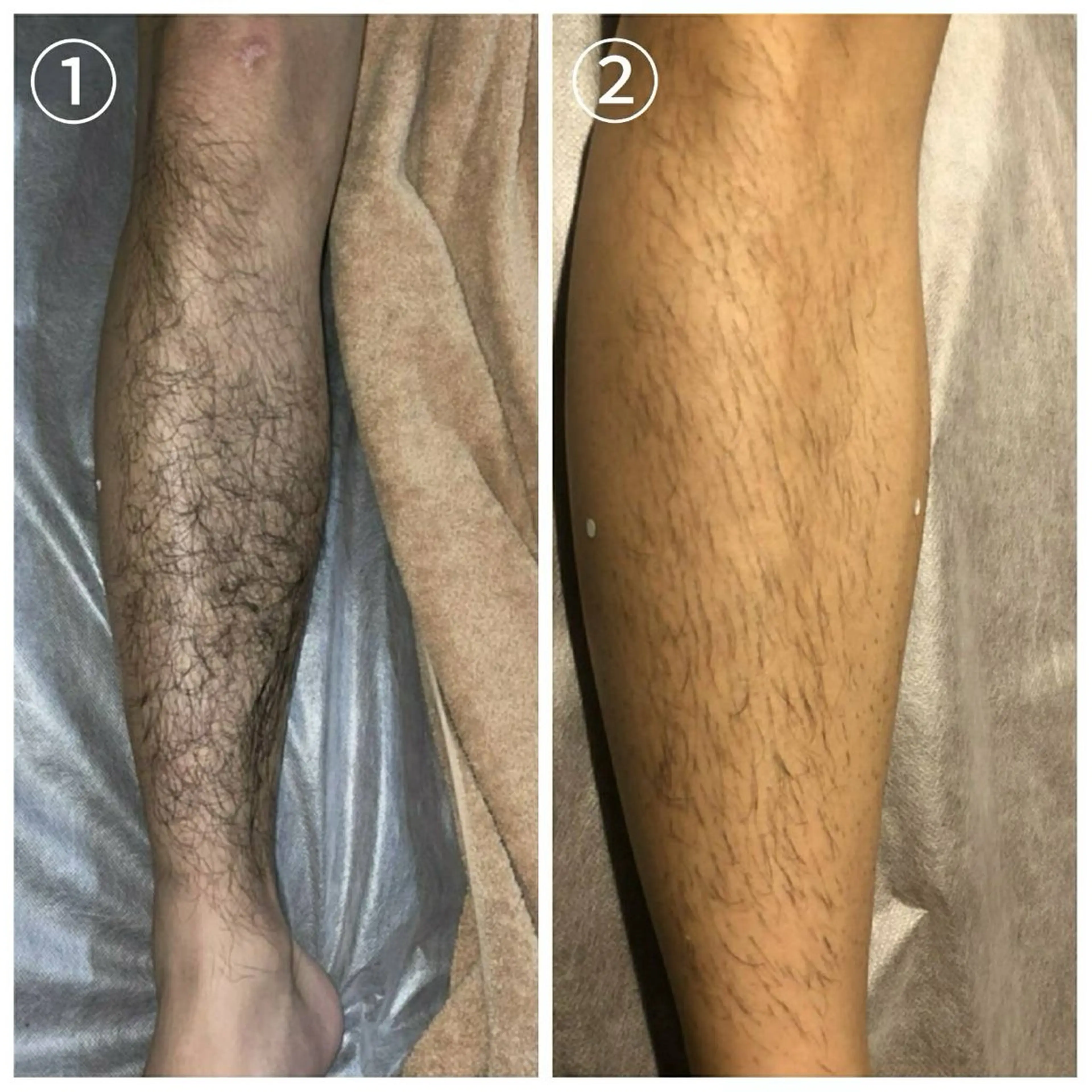 脱毛 LUMEN あやののエステ・リラクイメージ