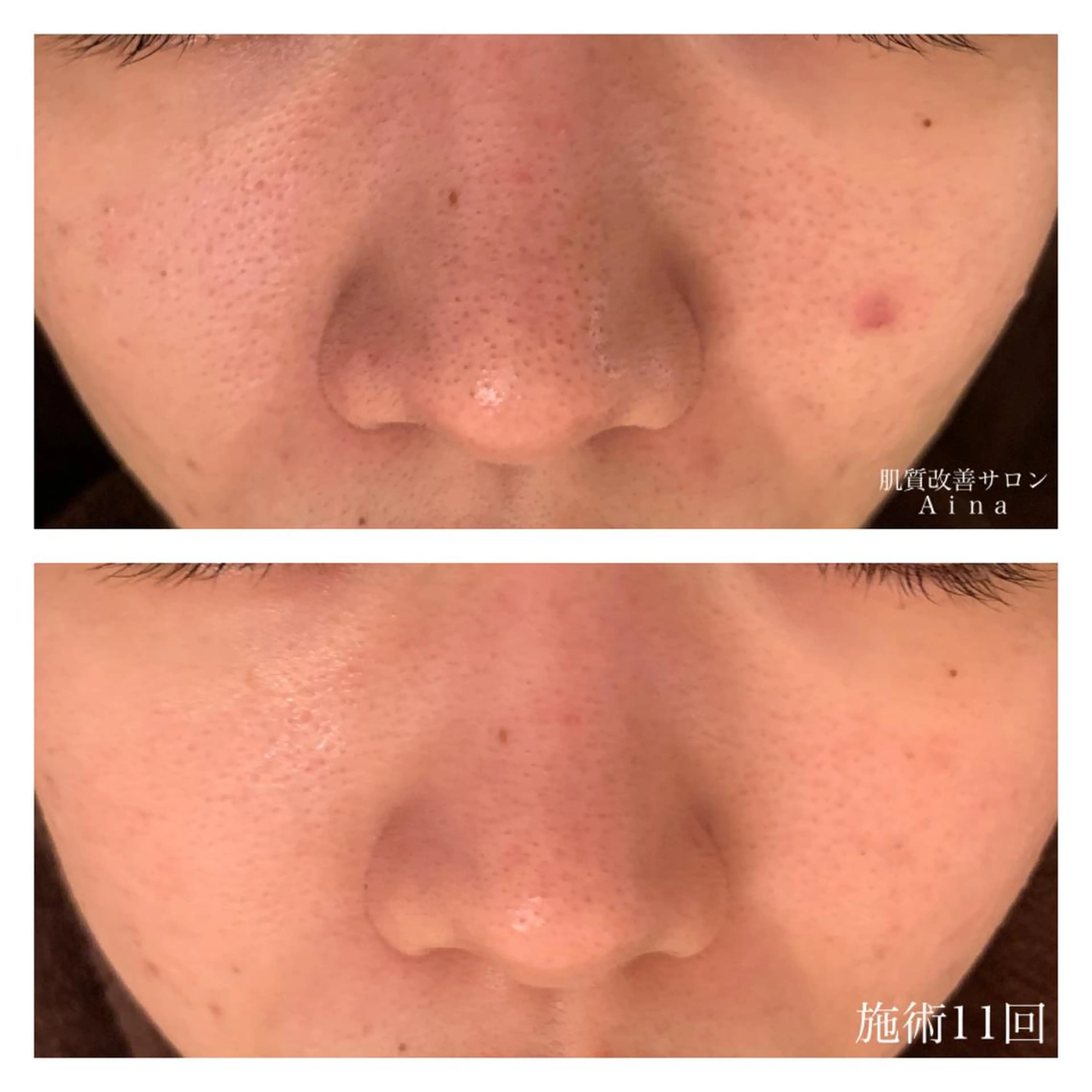 ミディアム カラー パーマ ヘアアレンジ メンズ キッズ ネイル マツエク・マツパ 卒業式のヘアスタイル 卒業式 ニキビ跡専門サロン Ａｉｎａのエステ・リラクイメージ