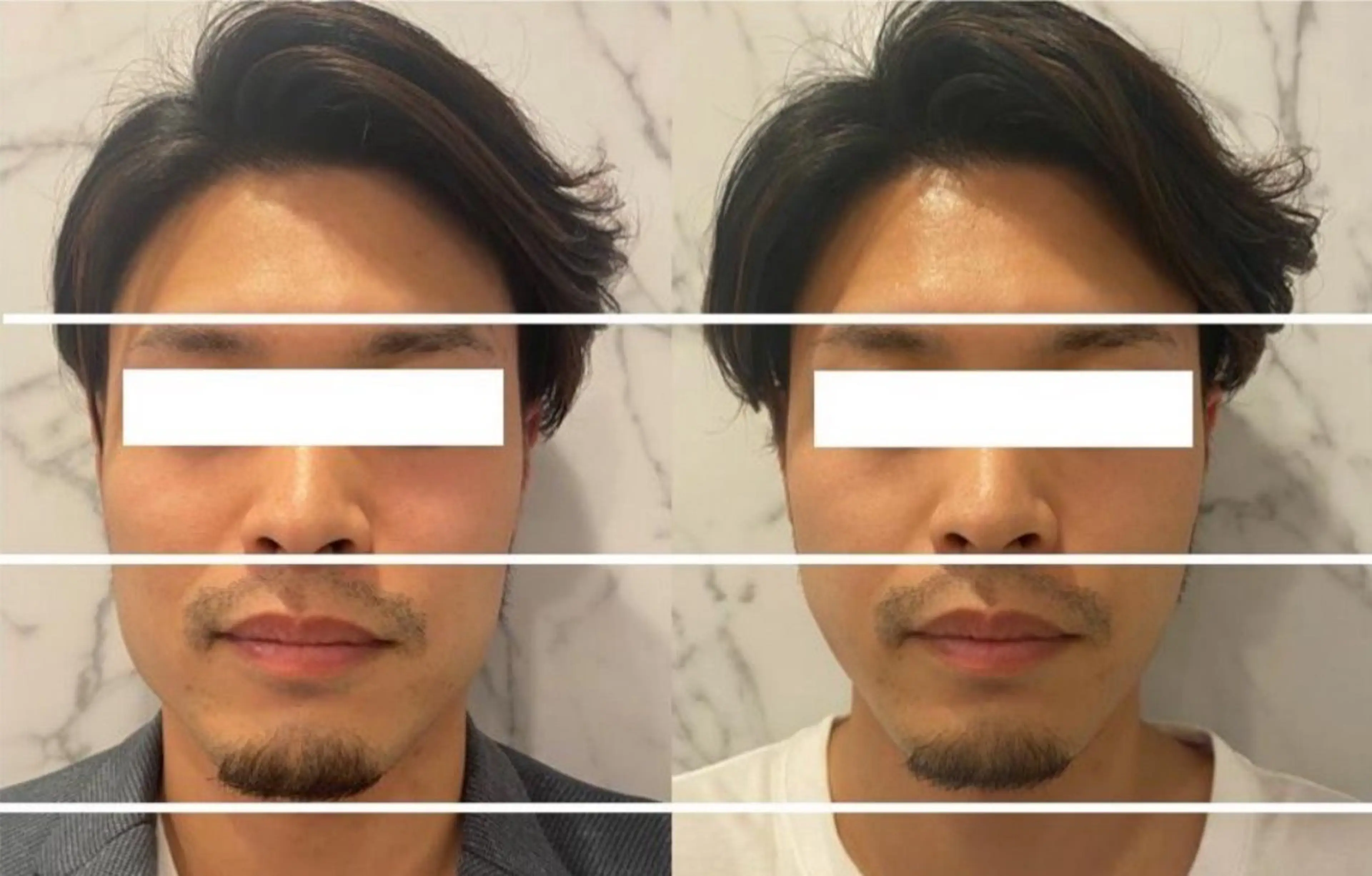 世界初美容機器　骨格調整付き　小顔形成術の写真