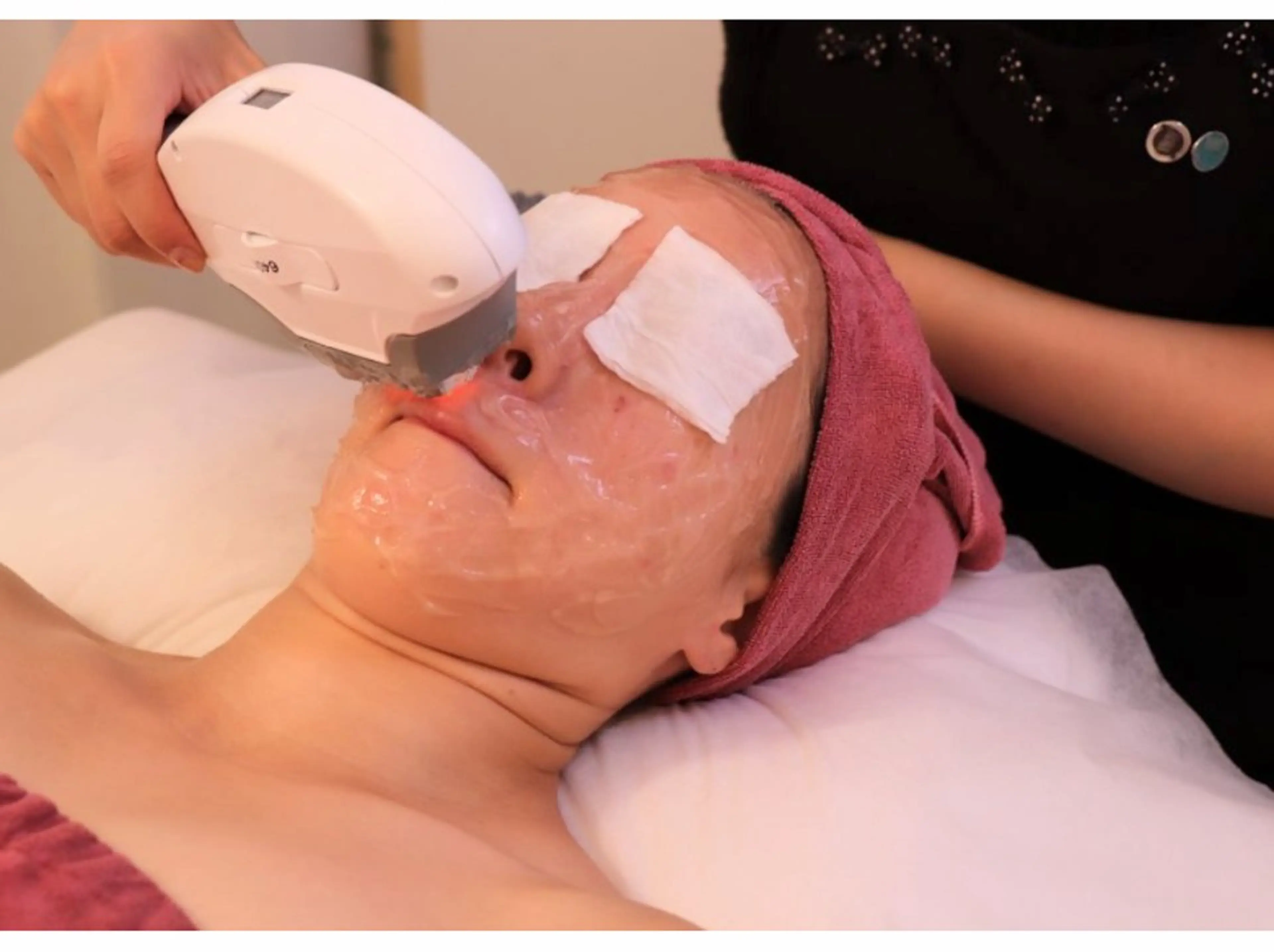 お顔すっきり脱毛の写真