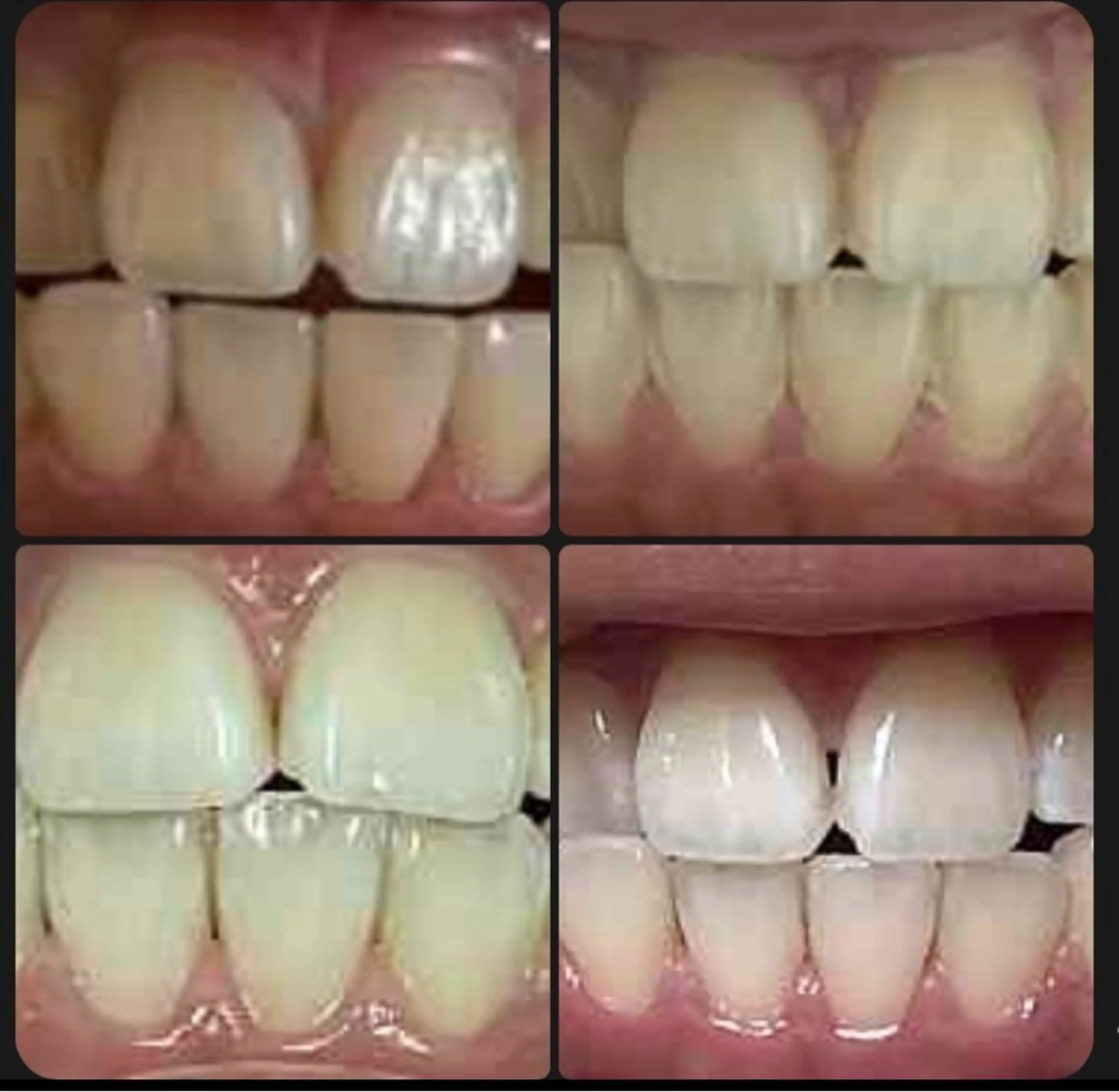 🦷セルフホワイトニングの写真